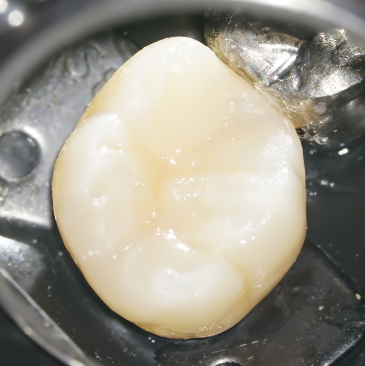 虫歯治療6治療方法07