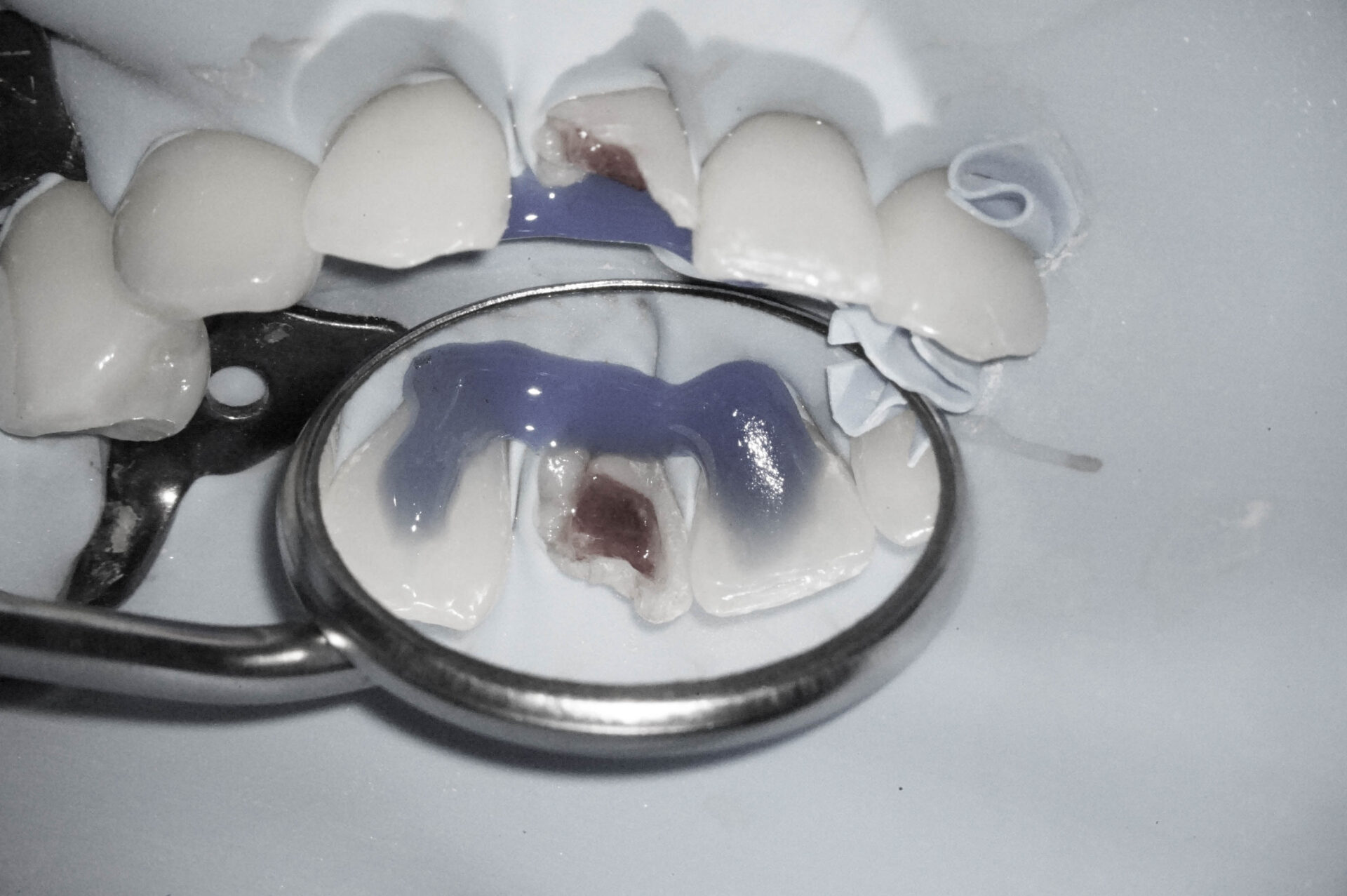 事故で歯が折れてしまった学生の方の治療(歯髄温存療法 MTAセメント)治療方法02