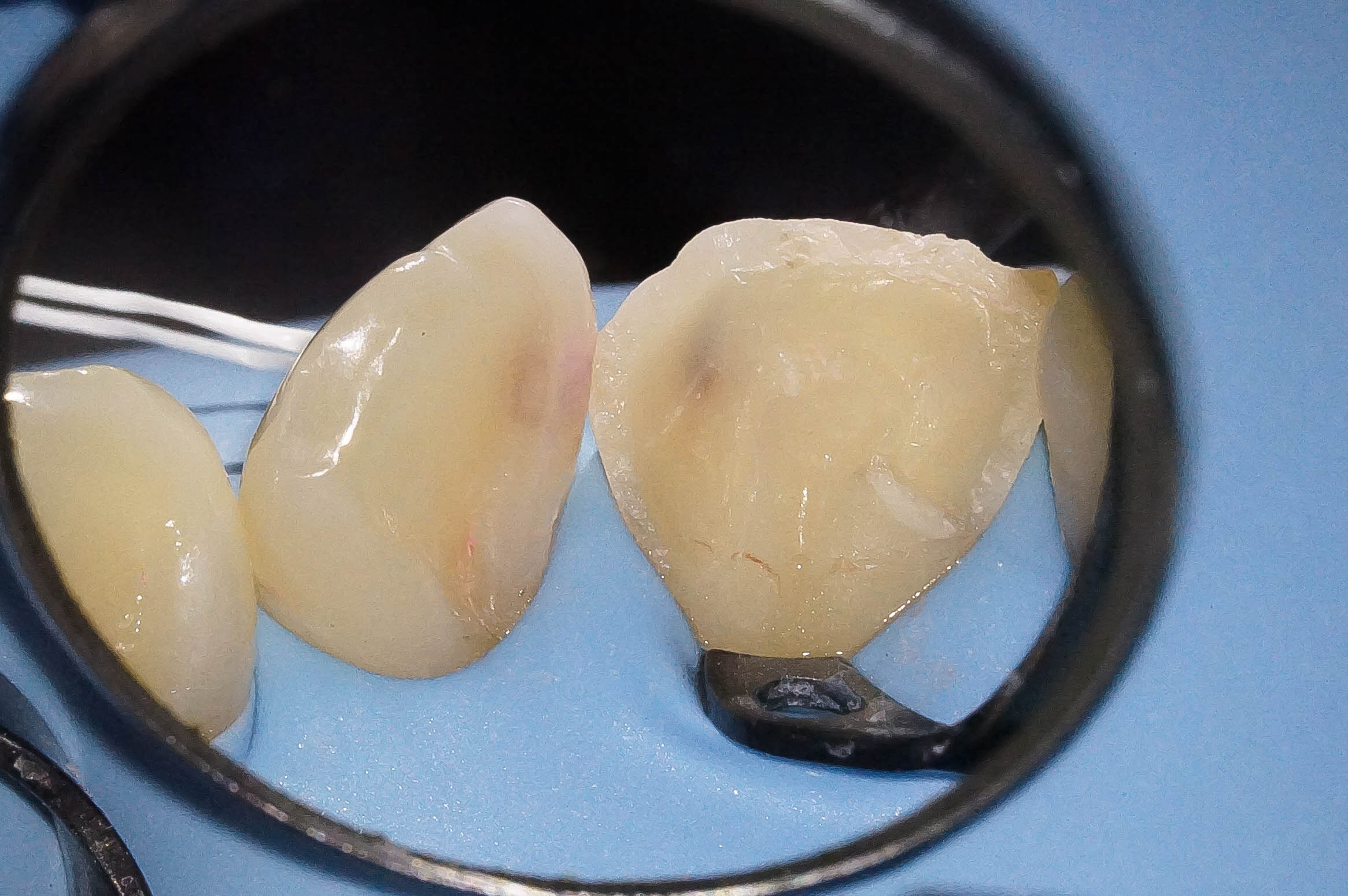 事故で歯が折れてしまった学生の方の治療(歯髄温存療法 MTAセメント)治療方法09