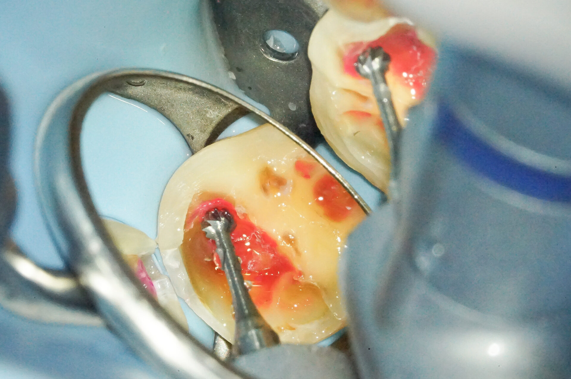 MTAセメントを使用した歯髄温存療法3治療方法04