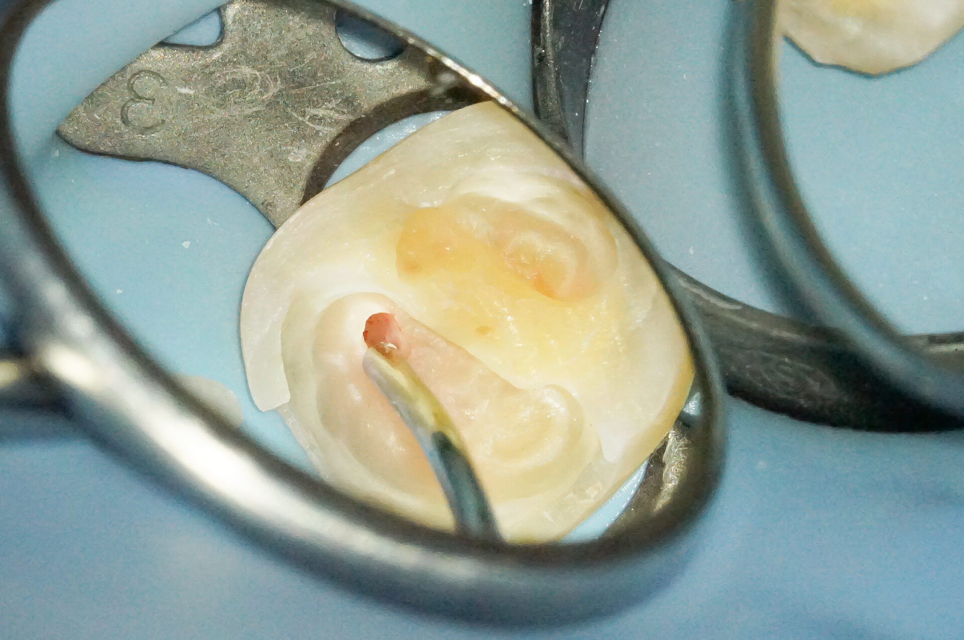 MTAセメントを使用した歯髄温存療法3治療方法09