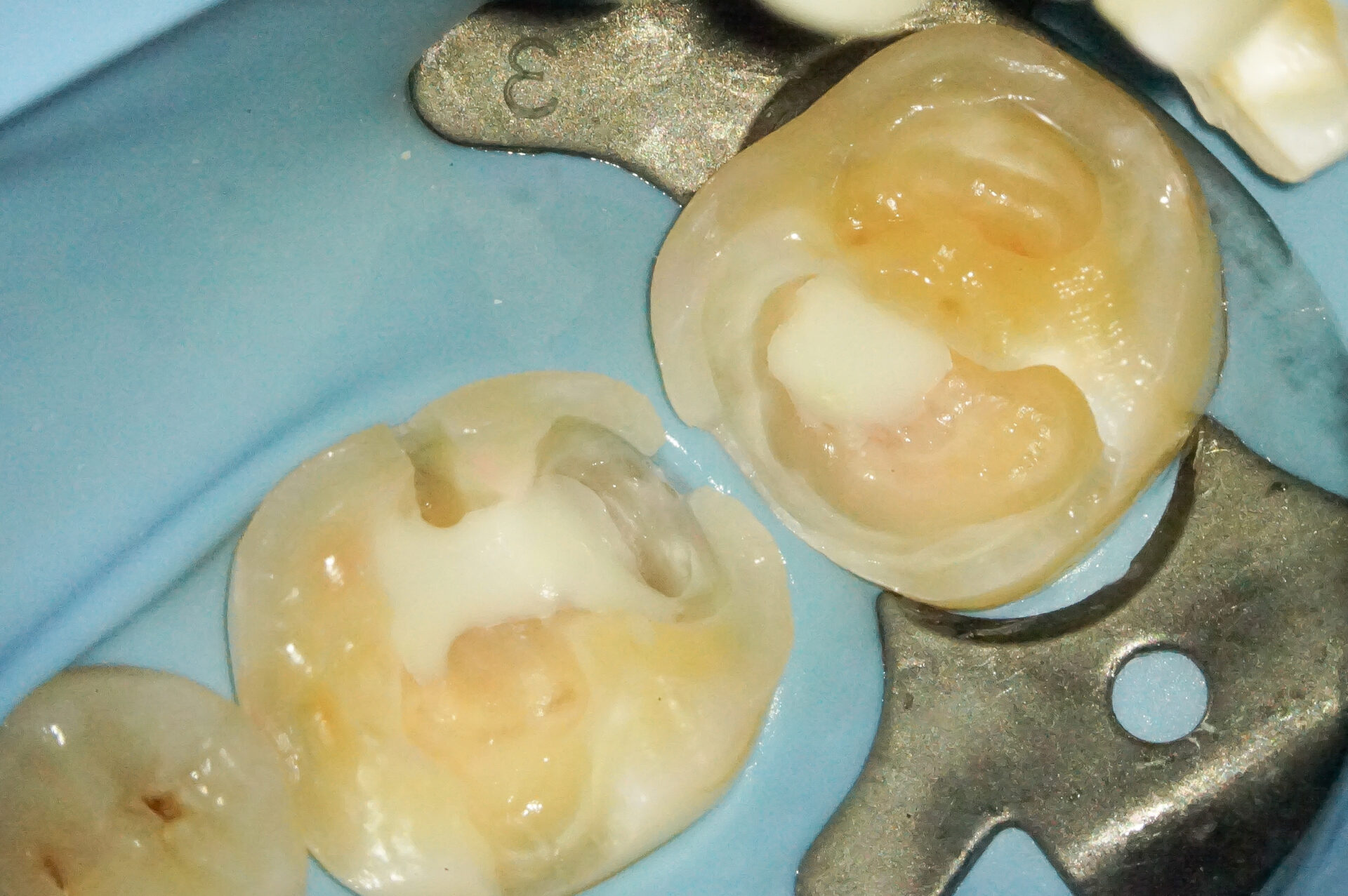 MTAセメントを使用した歯髄温存療法3治療方法10