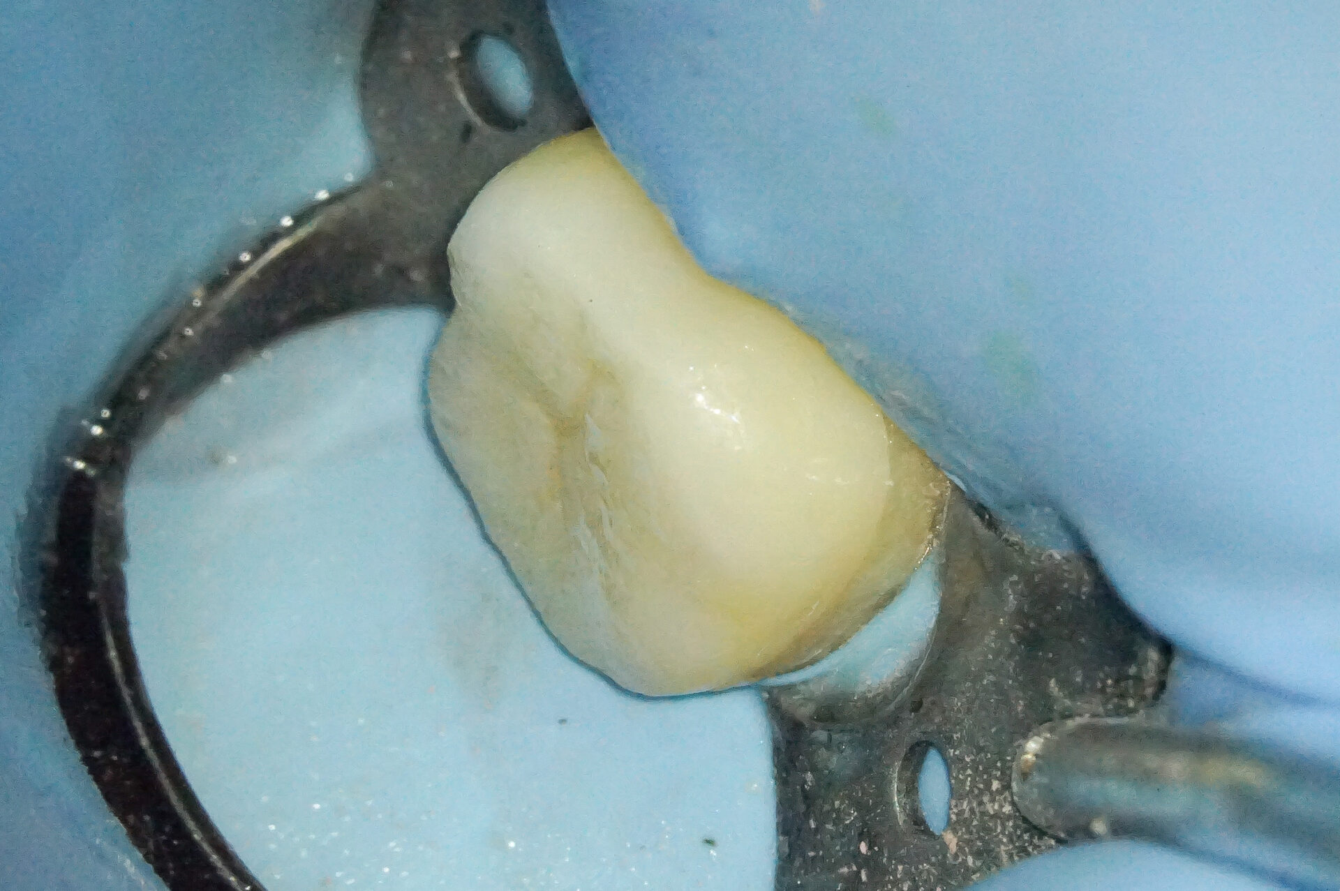 MTAセメントを使用した歯髄温存療法3治療方法13