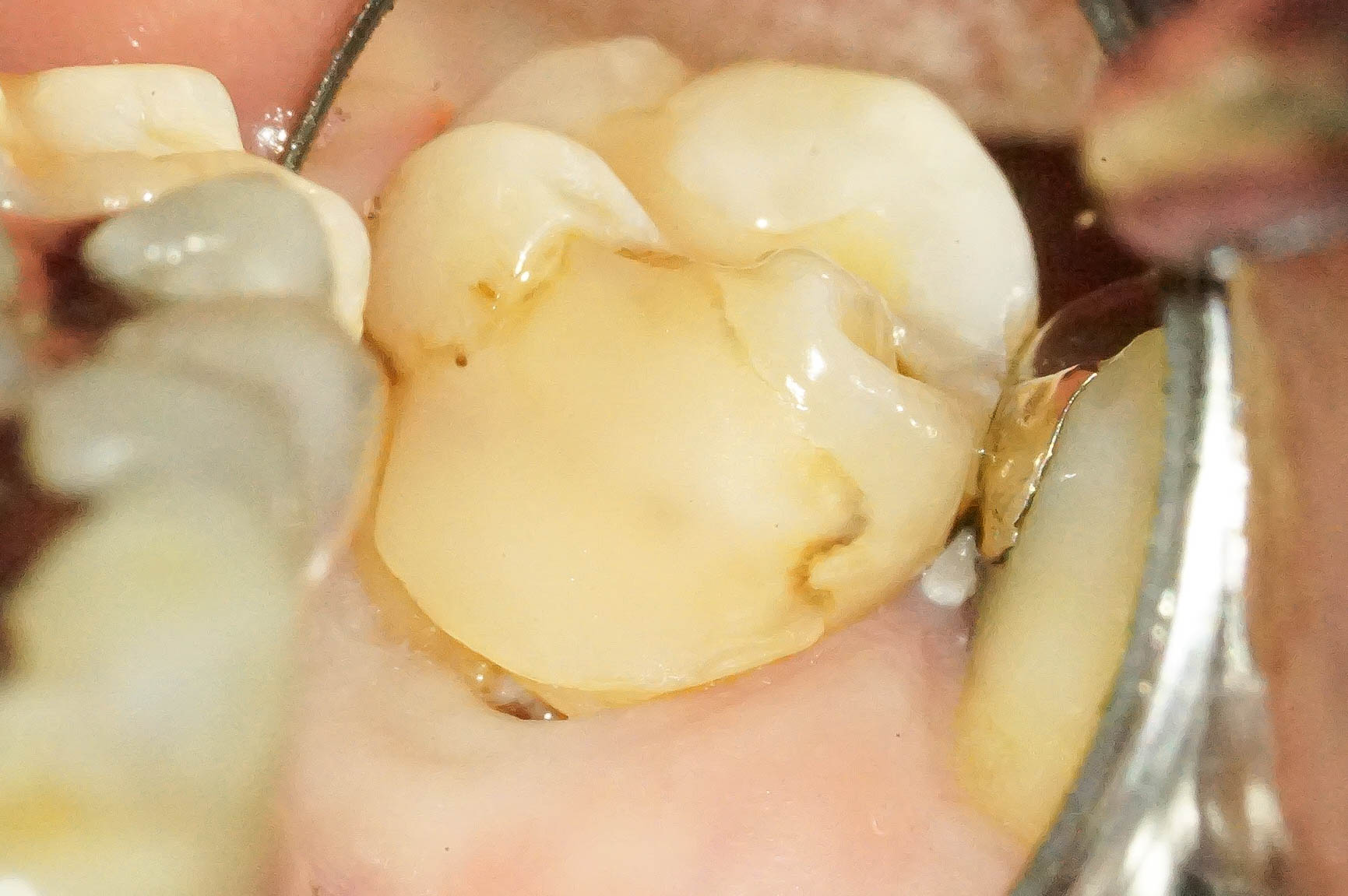 歯肉縁下ダイレクトボンディングを行った症例治療方法01