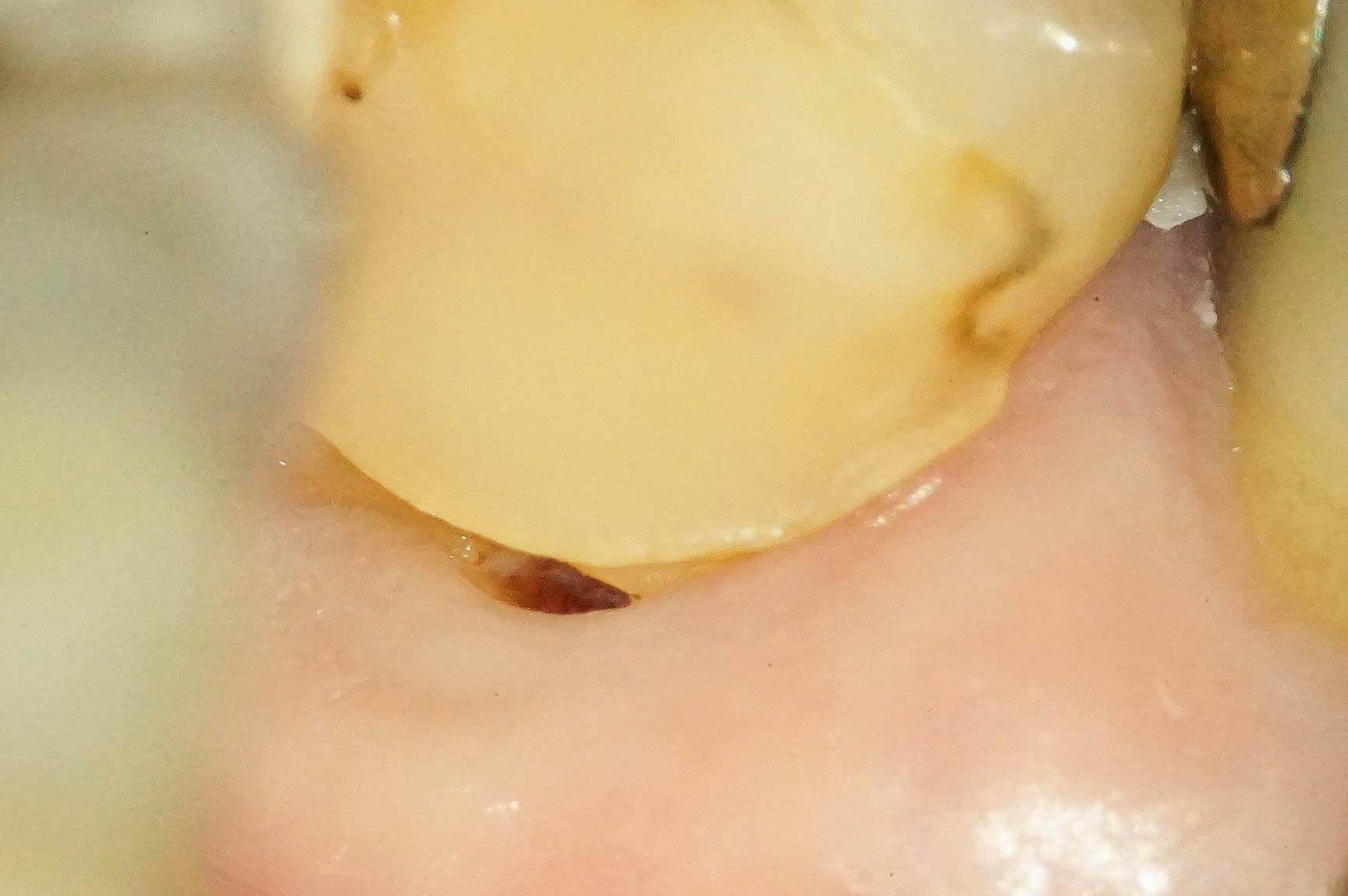 歯肉縁下ダイレクトボンディングを行った症例治療方法02