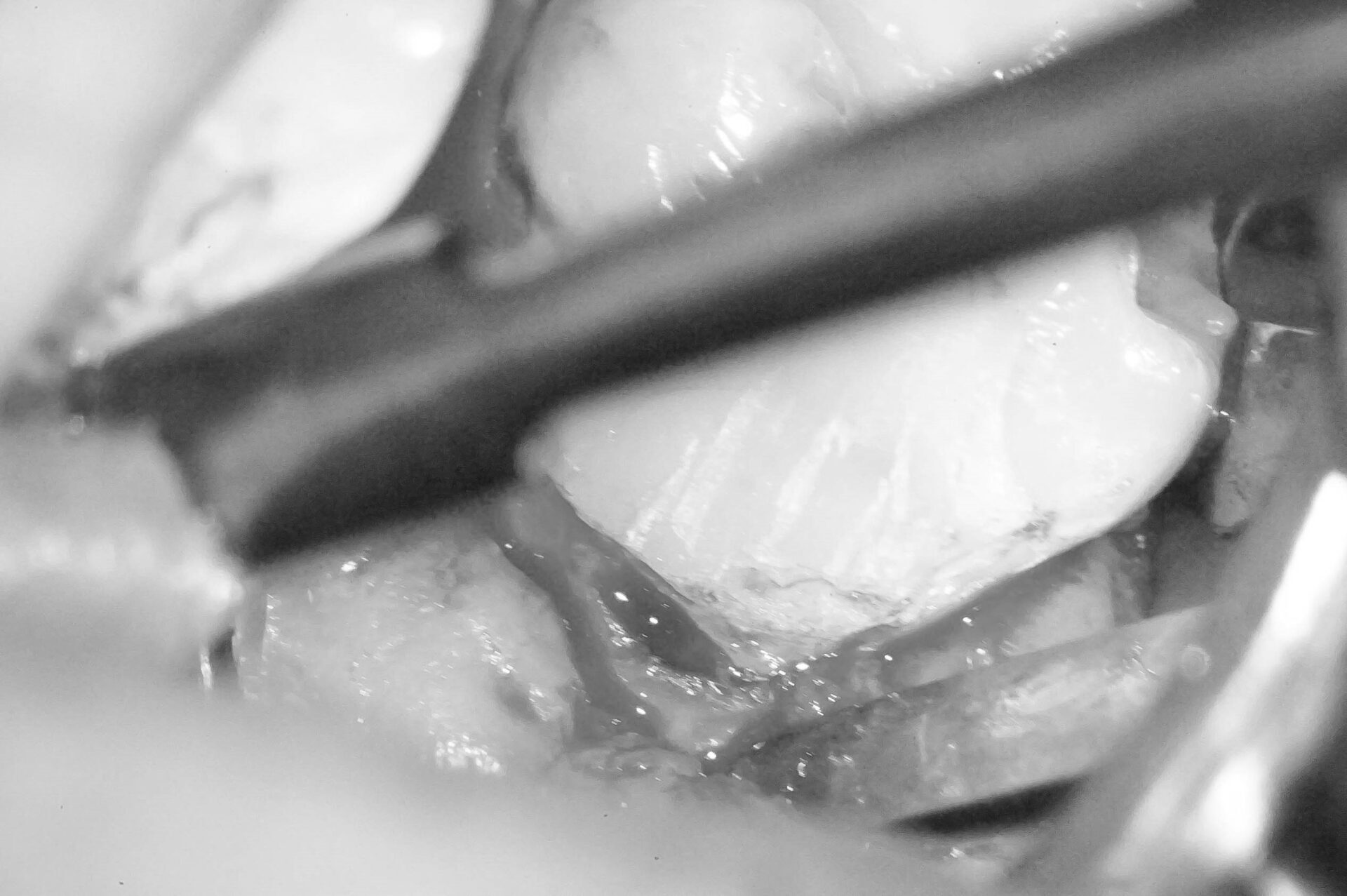 歯肉縁下ダイレクトボンディングを行った症例治療方法03