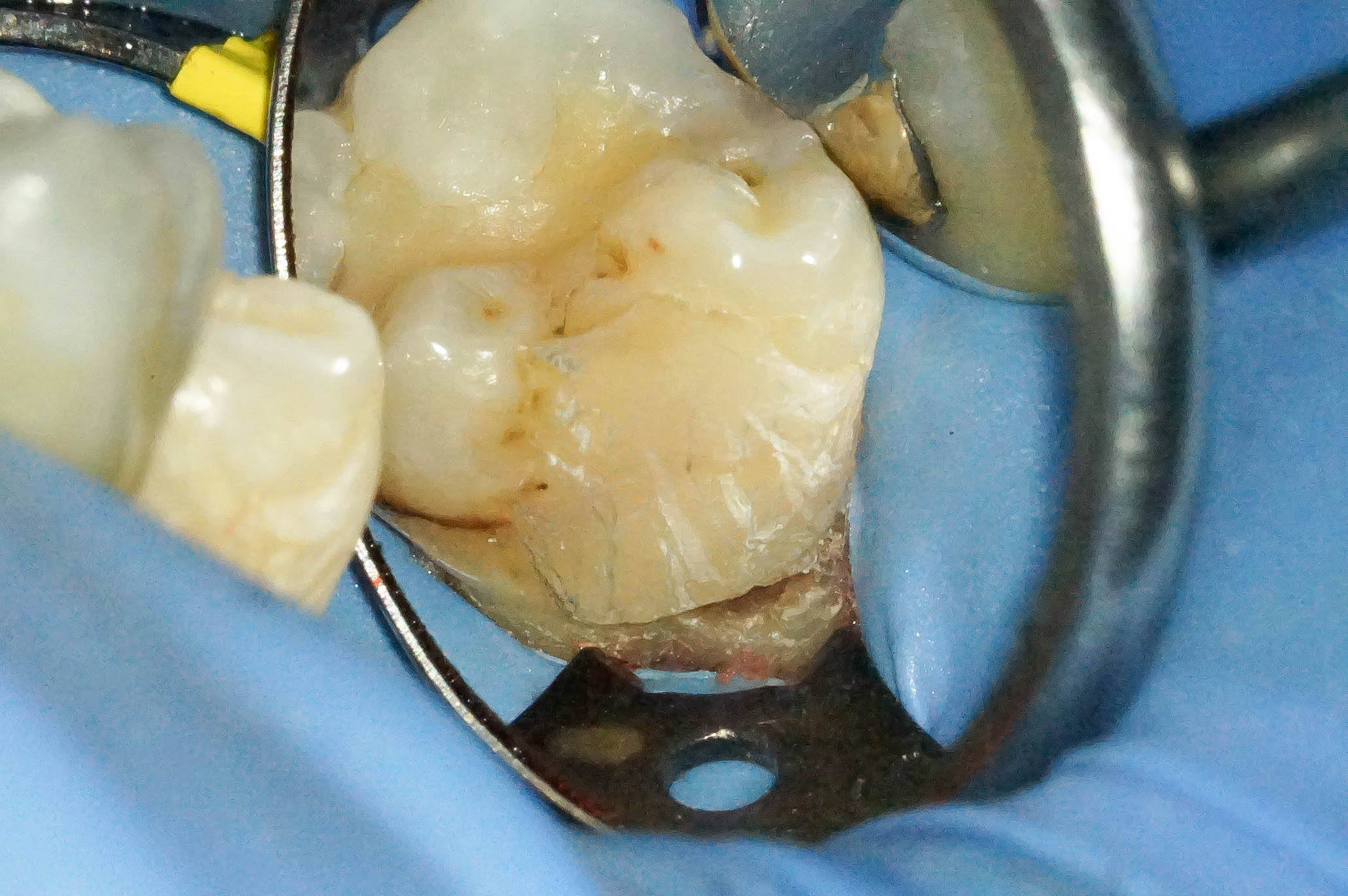 歯肉縁下ダイレクトボンディングを行った症例治療方法04