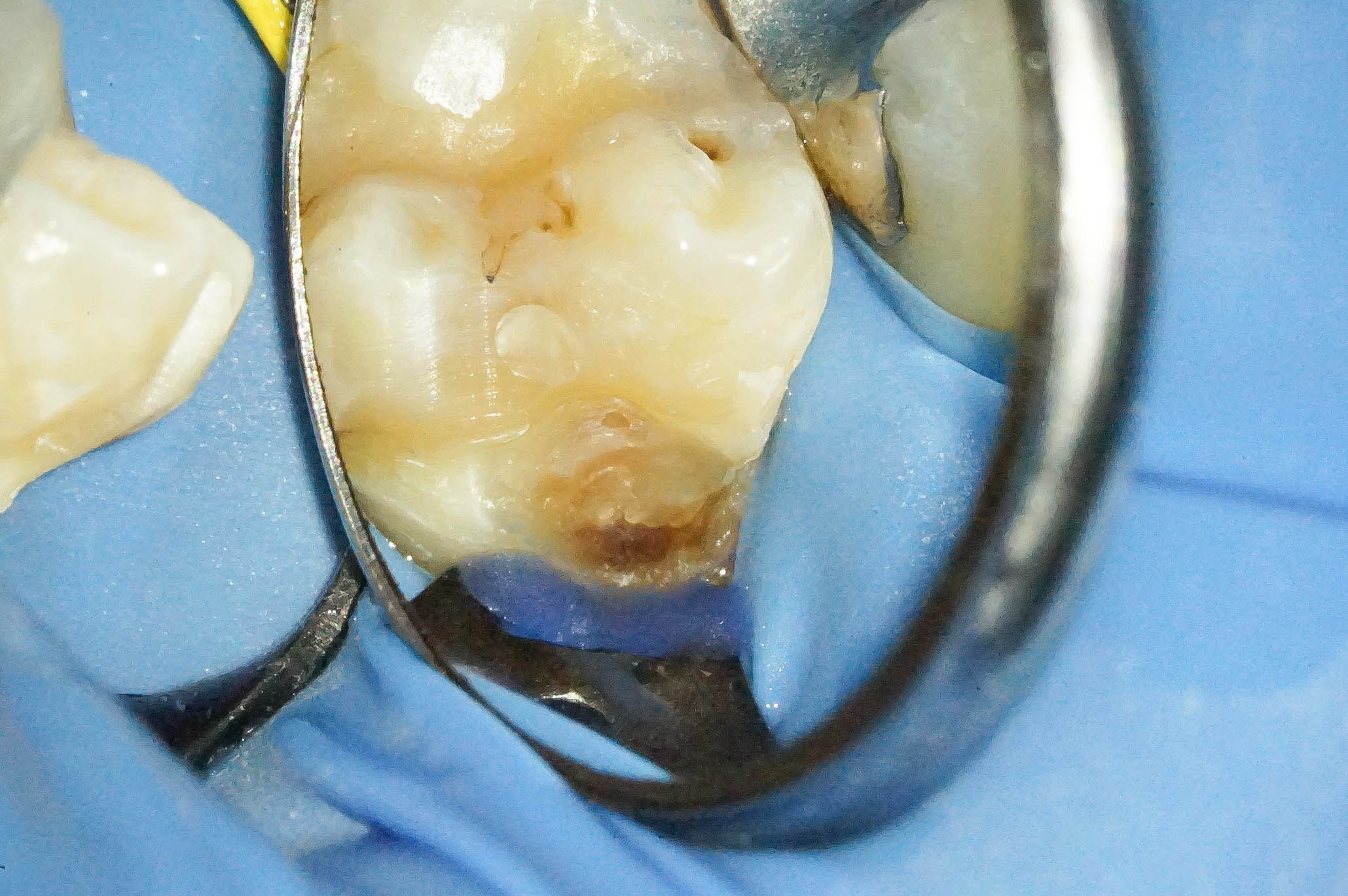 歯肉縁下ダイレクトボンディングを行った症例治療方法05