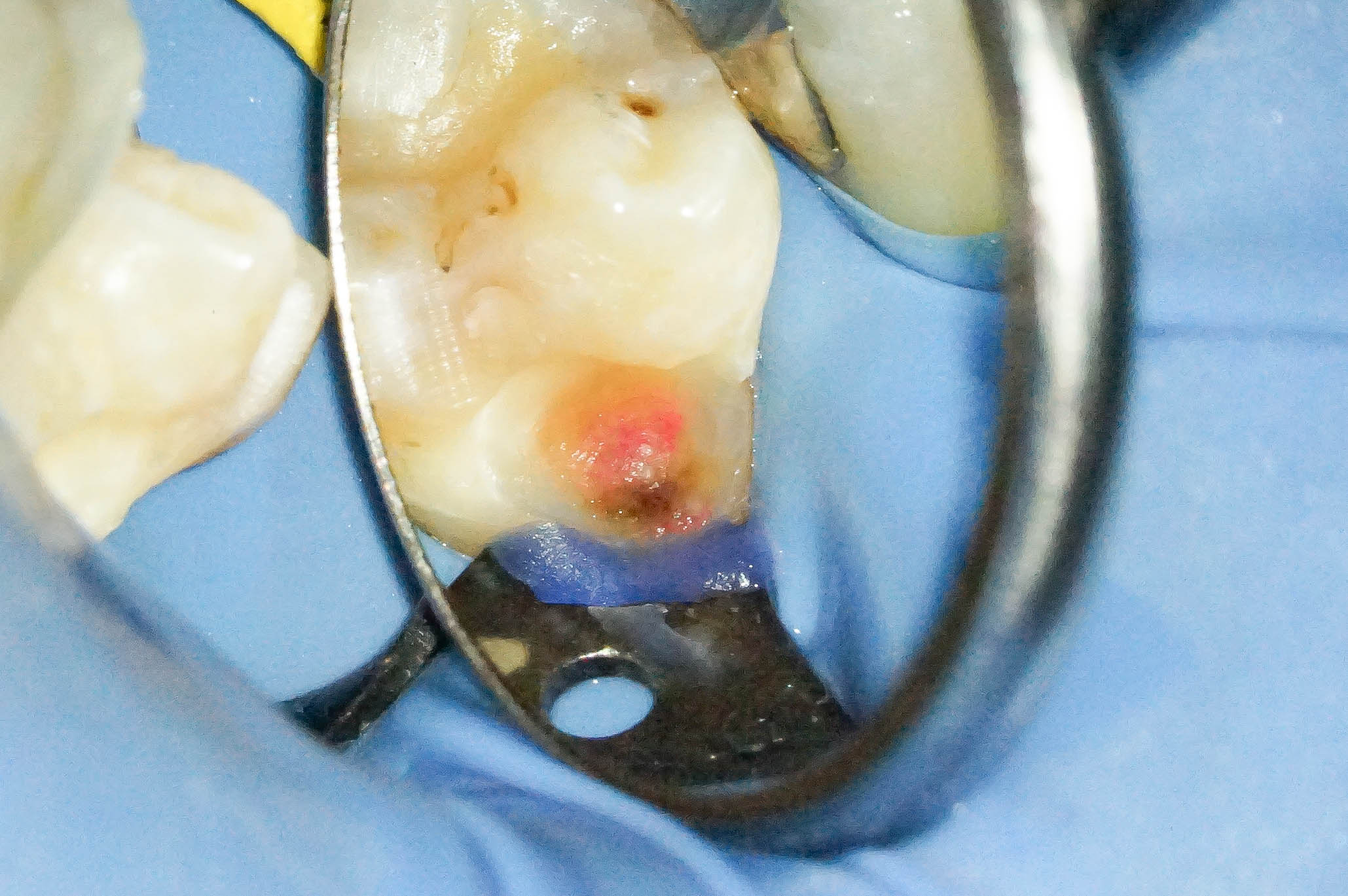 歯肉縁下ダイレクトボンディングを行った症例治療方法06