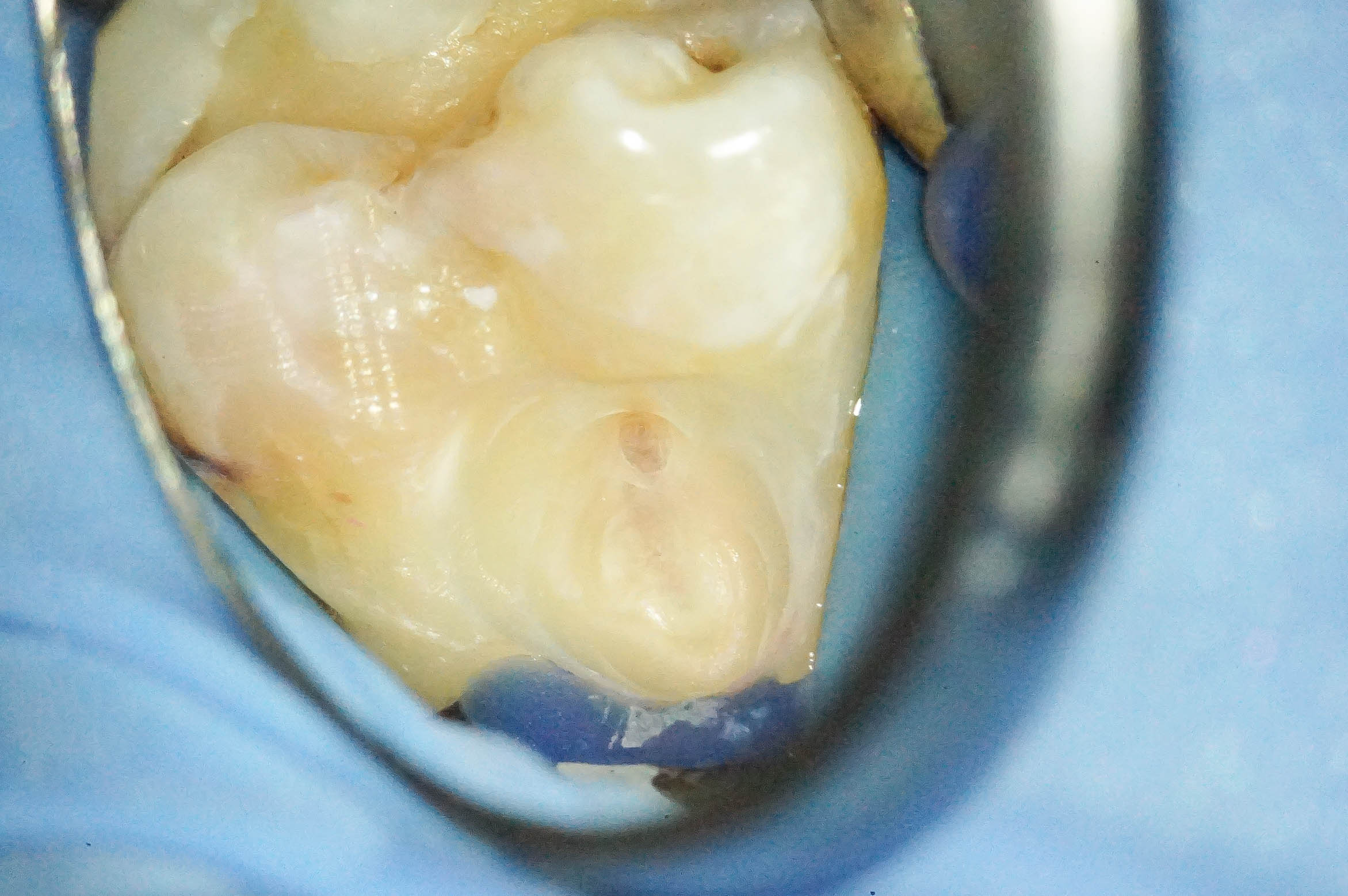 歯肉縁下ダイレクトボンディングを行った症例治療方法07