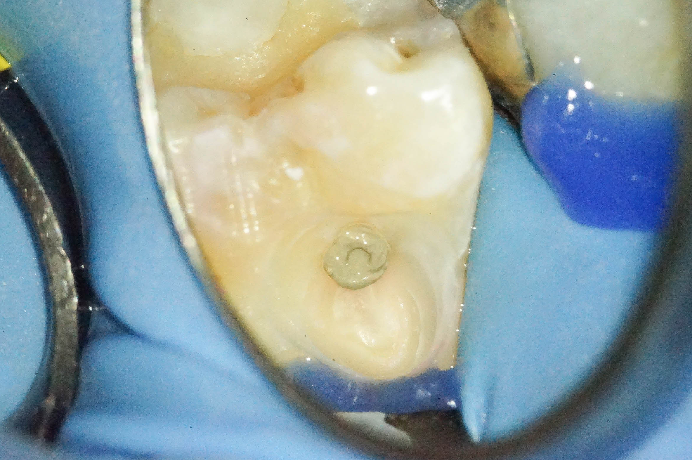 歯肉縁下ダイレクトボンディングを行った症例治療方法08