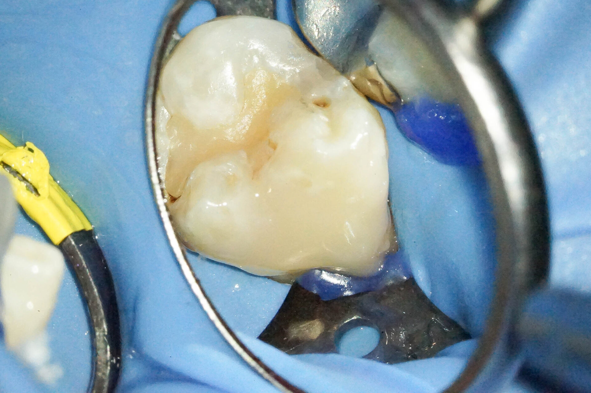 歯肉縁下ダイレクトボンディングを行った症例治療方法09