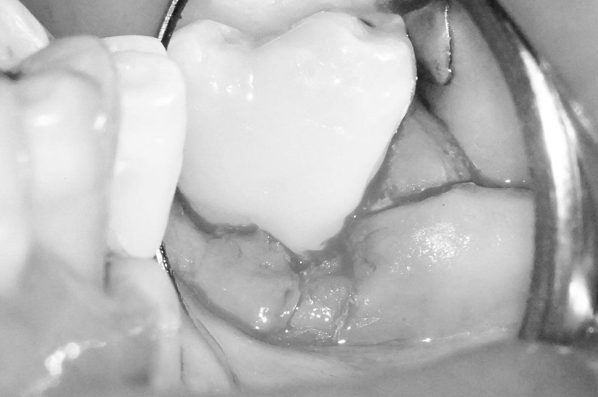 歯肉縁下ダイレクトボンディングを行った症例治療方法10