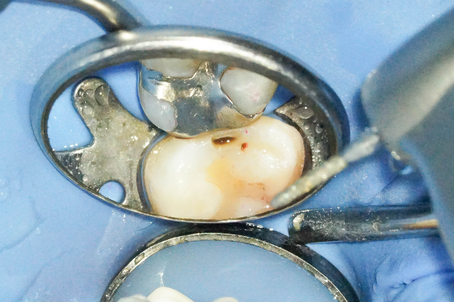 歯肉縁下ダイレクトボンディングを行った症例治療方法11