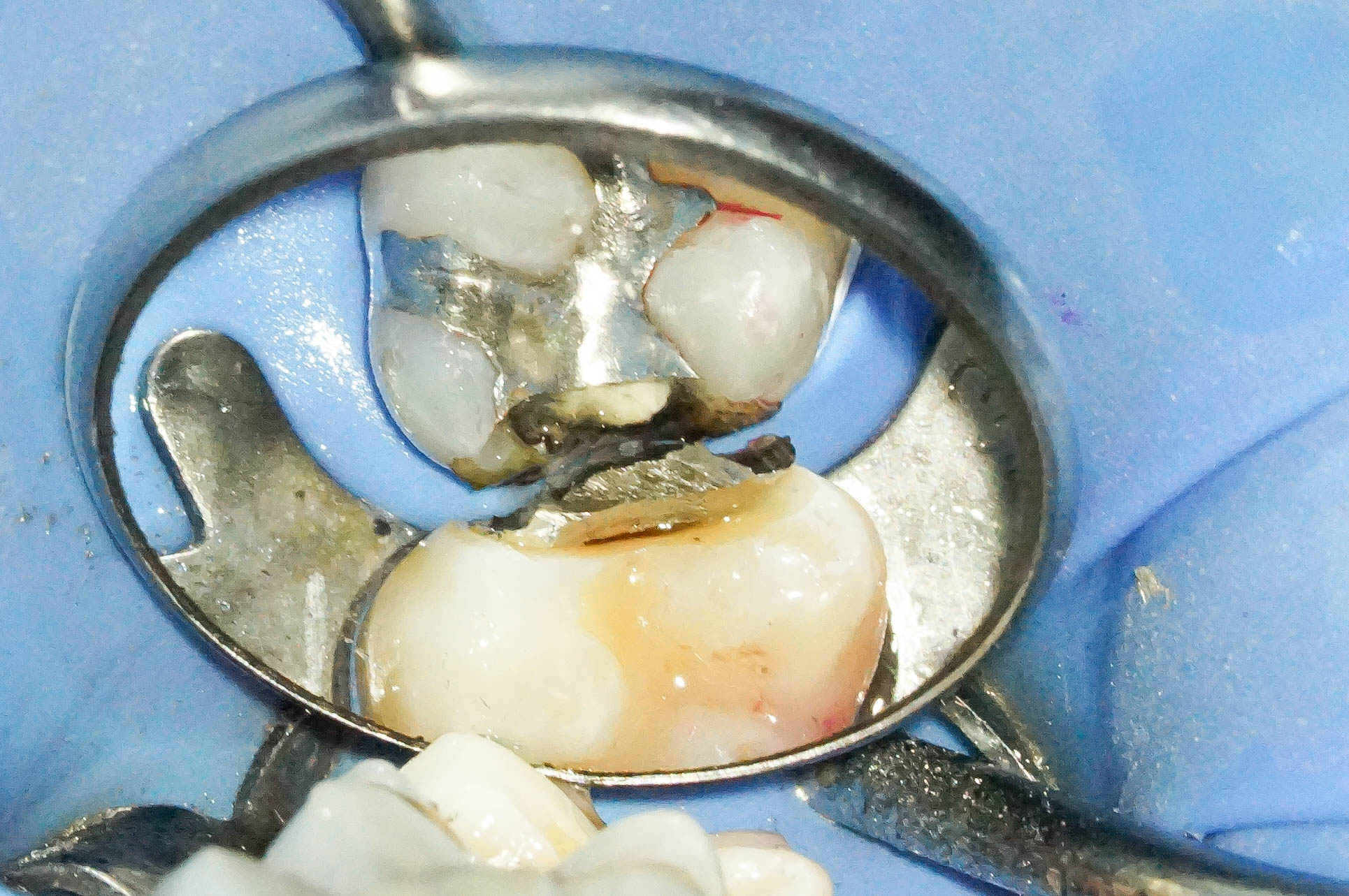 歯肉縁下ダイレクトボンディングを行った症例治療方法12