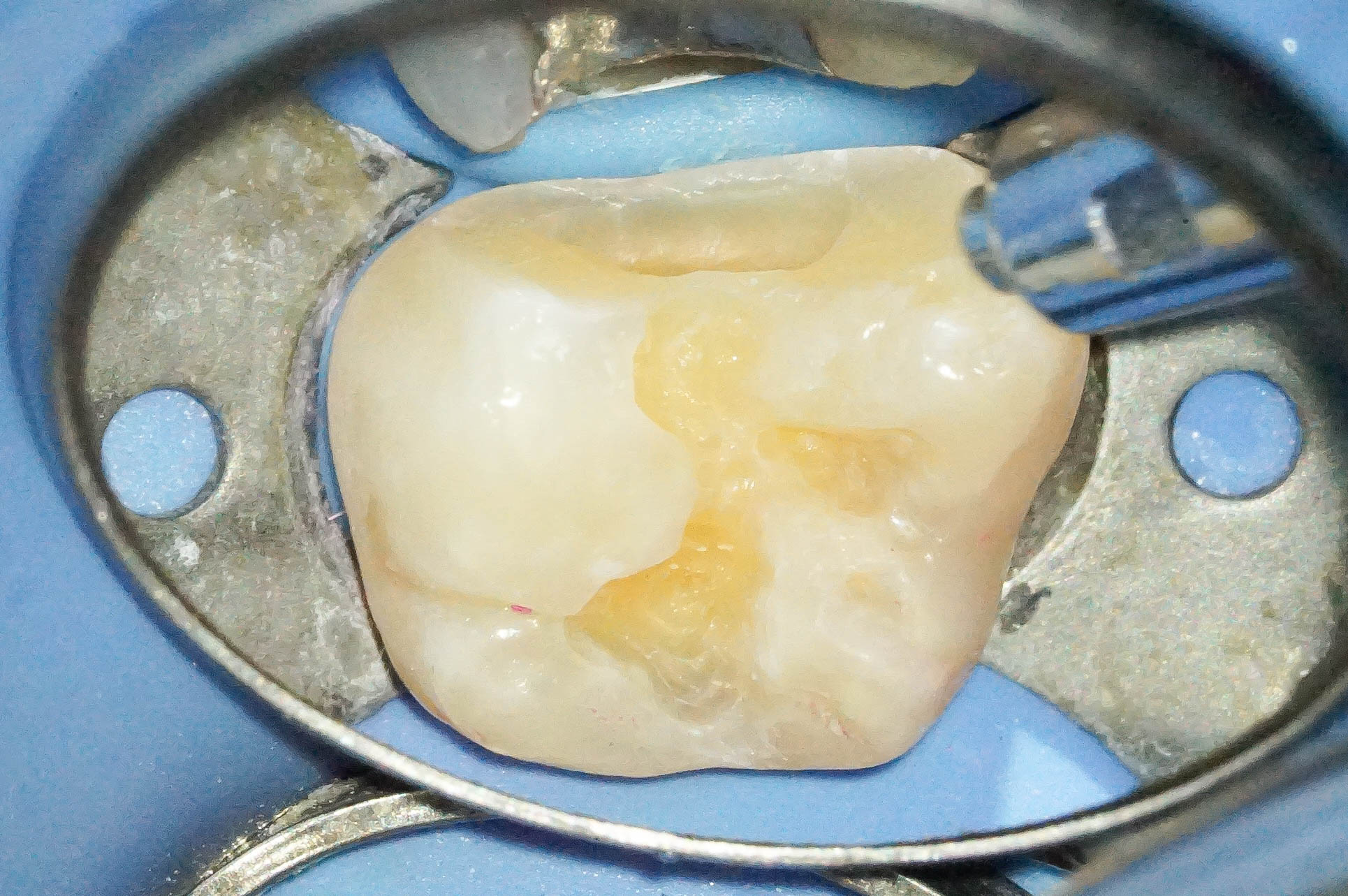 歯肉縁下ダイレクトボンディングを行った症例治療方法13