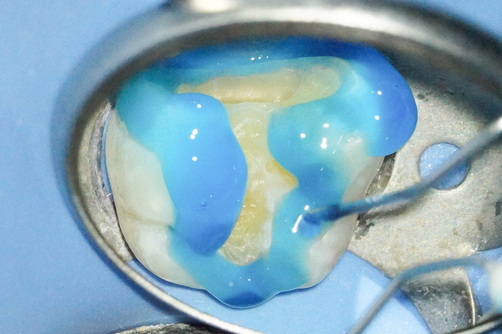 歯肉縁下ダイレクトボンディングを行った症例治療方法14