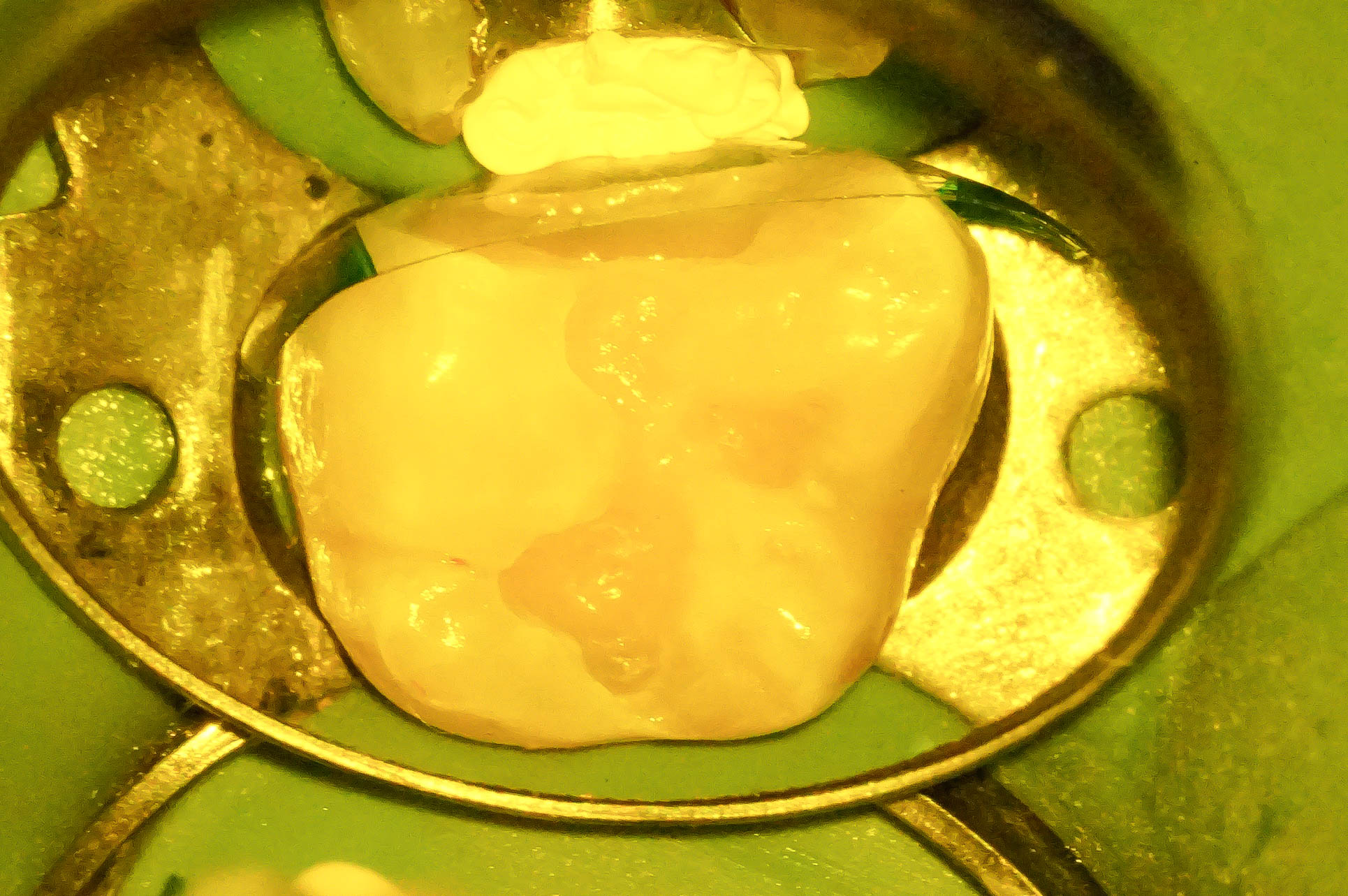 歯肉縁下ダイレクトボンディングを行った症例治療方法15