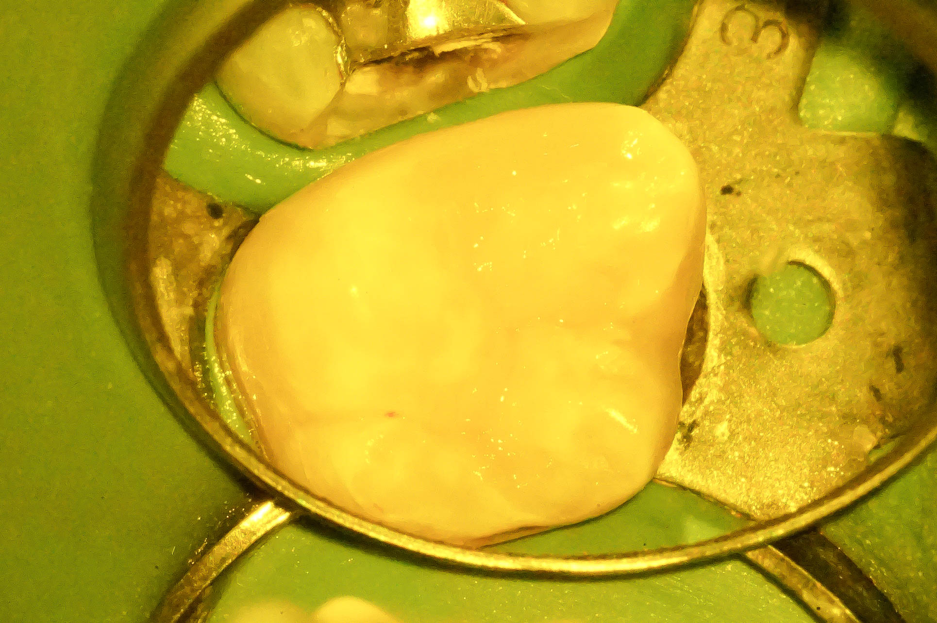 歯肉縁下ダイレクトボンディングを行った症例治療方法16