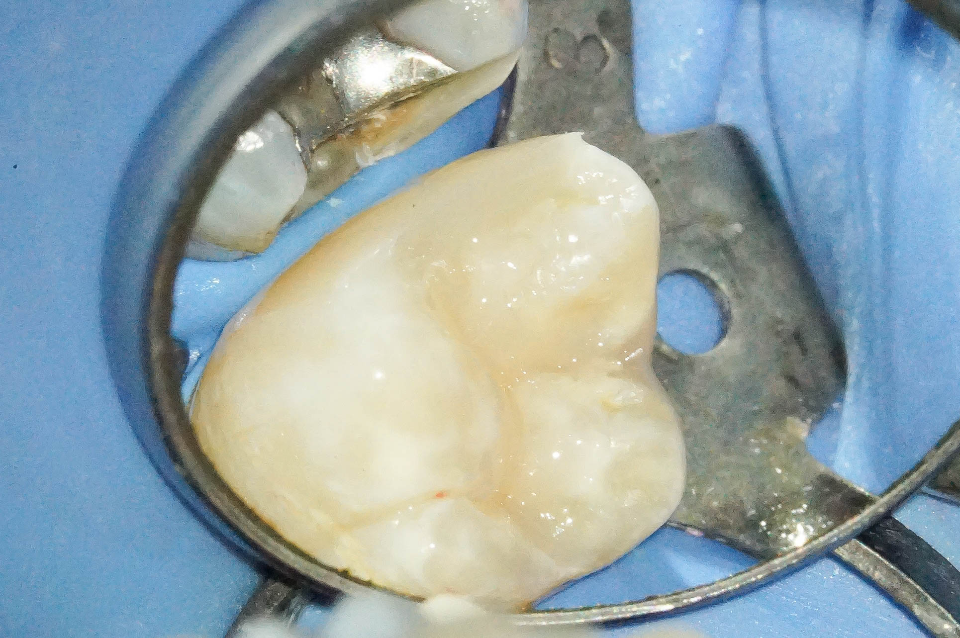 歯肉縁下ダイレクトボンディングを行った症例治療方法17