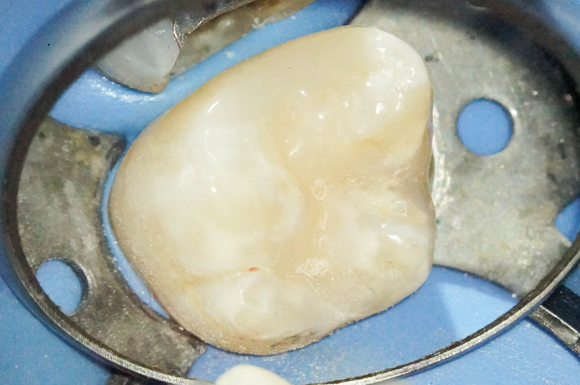 歯肉縁下ダイレクトボンディングを行った症例治療方法18