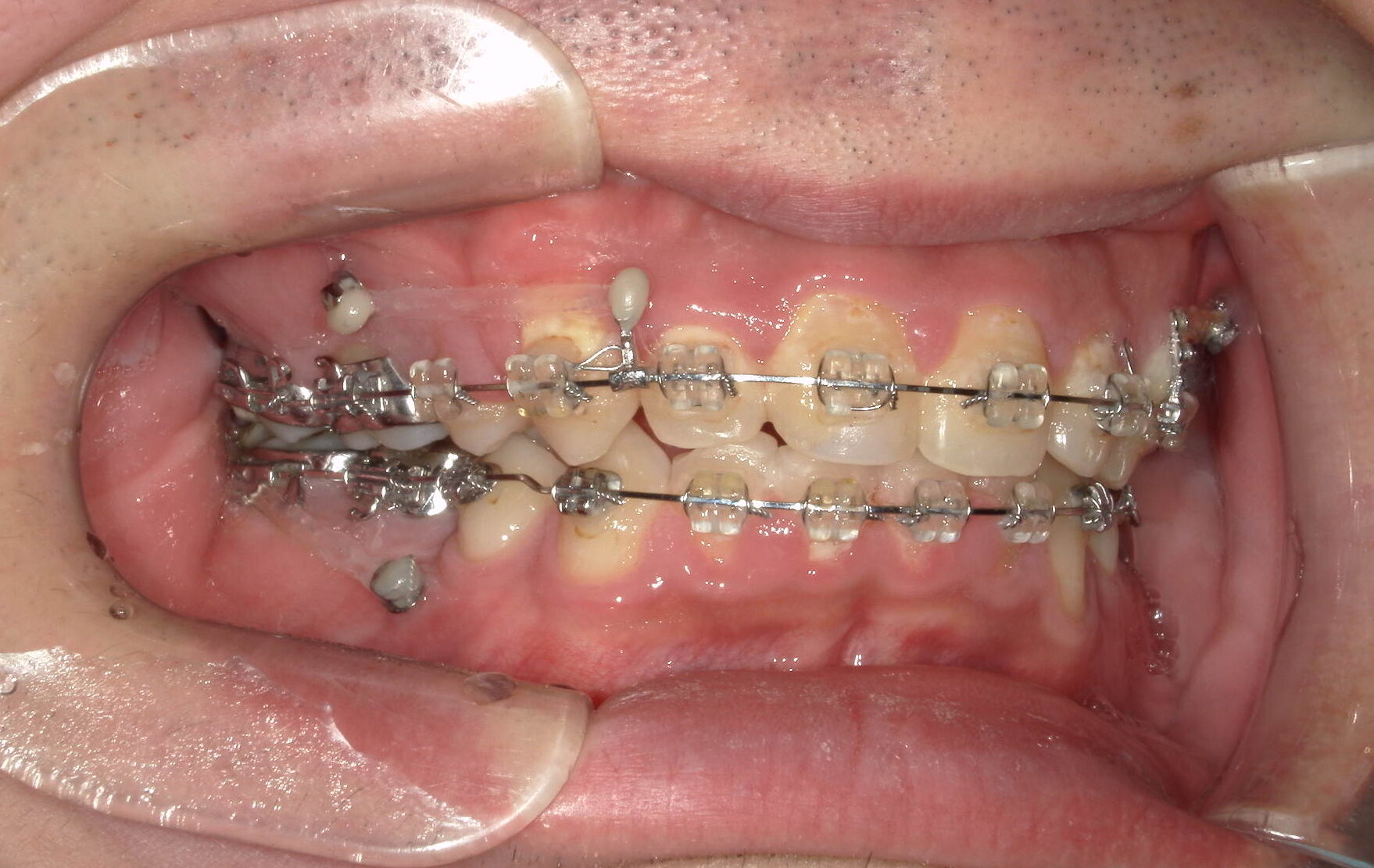 歯科矯正用アンカースクリューを用いて叢生と上下歯列正中の不一致を改善した症例治療方法06