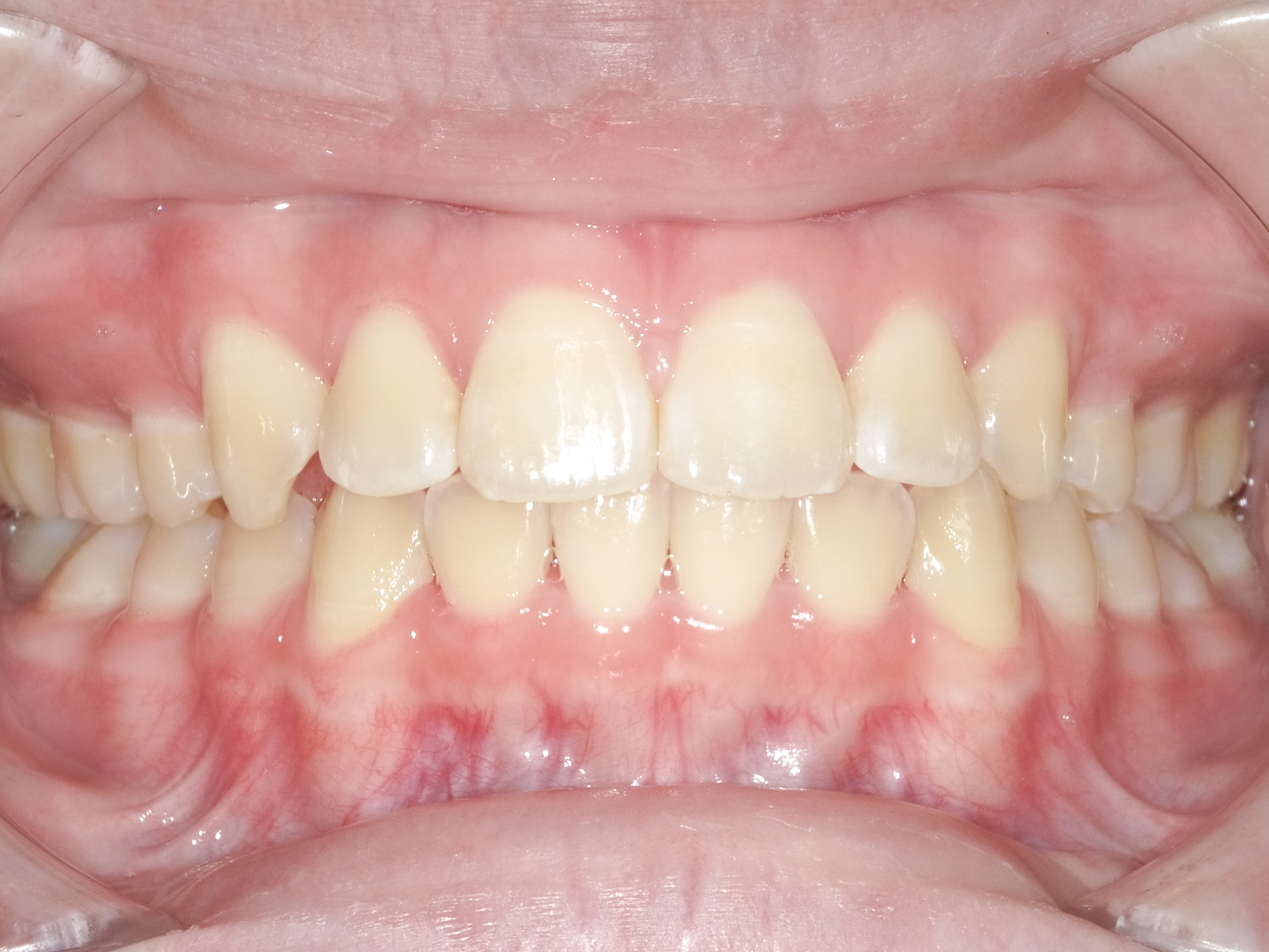 前歯のガタガタ、でっ歯に全体矯正を行なった症例治療方法07