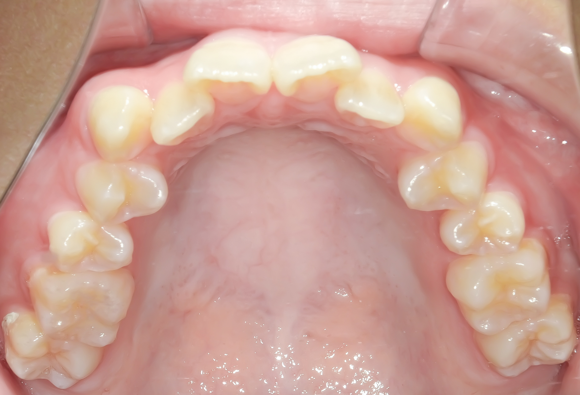 前歯のガタガタ、でっ歯に全体矯正を行なった症例治療方法01
