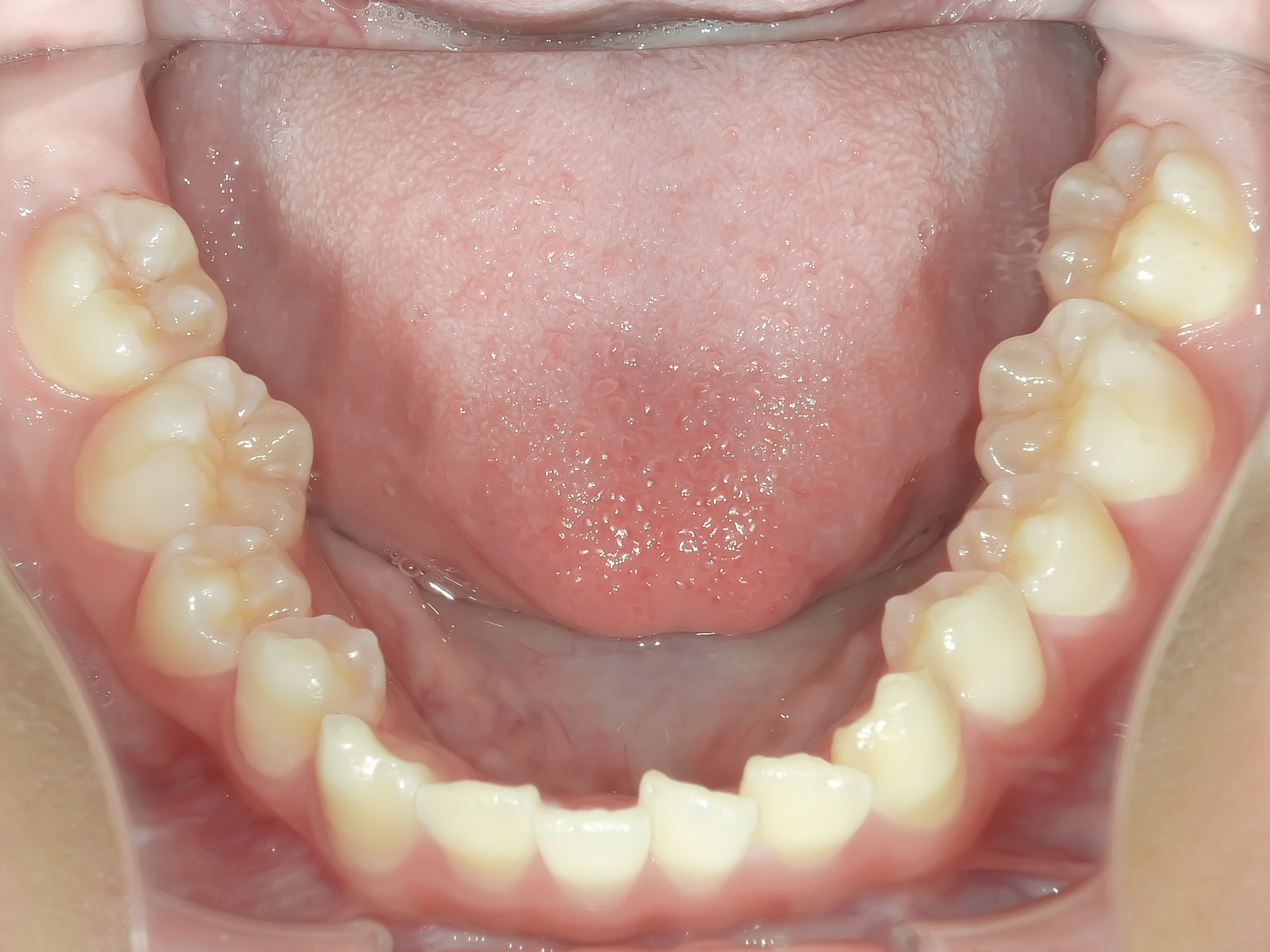 前歯のガタガタ、でっ歯に全体矯正を行なった症例治療方法02