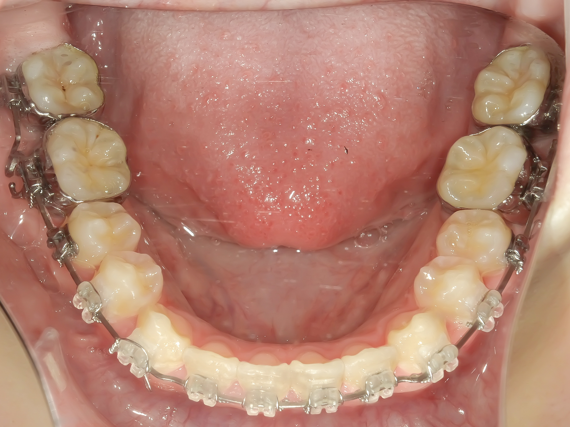 前歯のガタガタ、でっ歯に全体矯正を行なった症例治療方法04