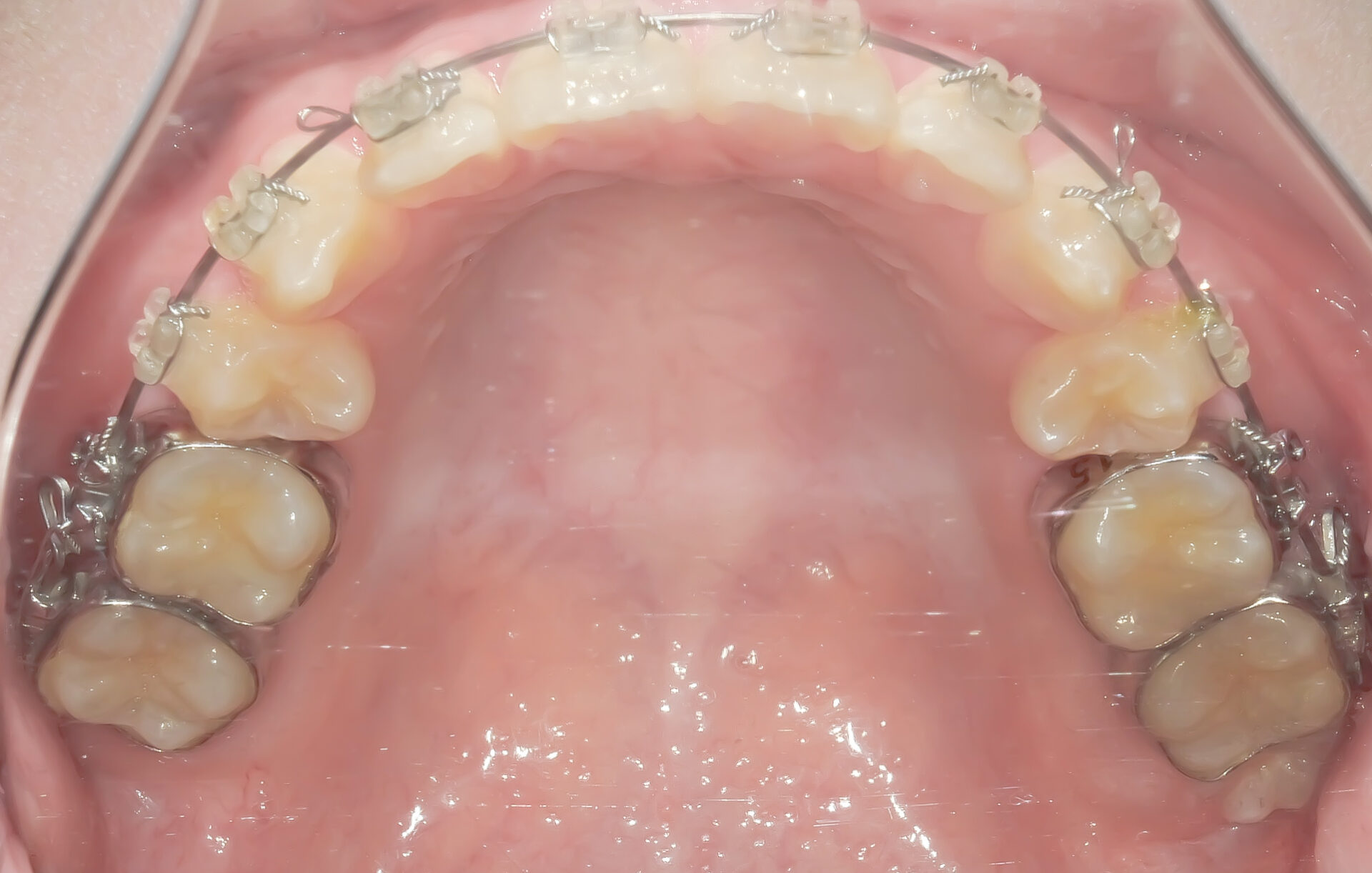 前歯のガタガタ、でっ歯に全体矯正を行なった症例治療方法03