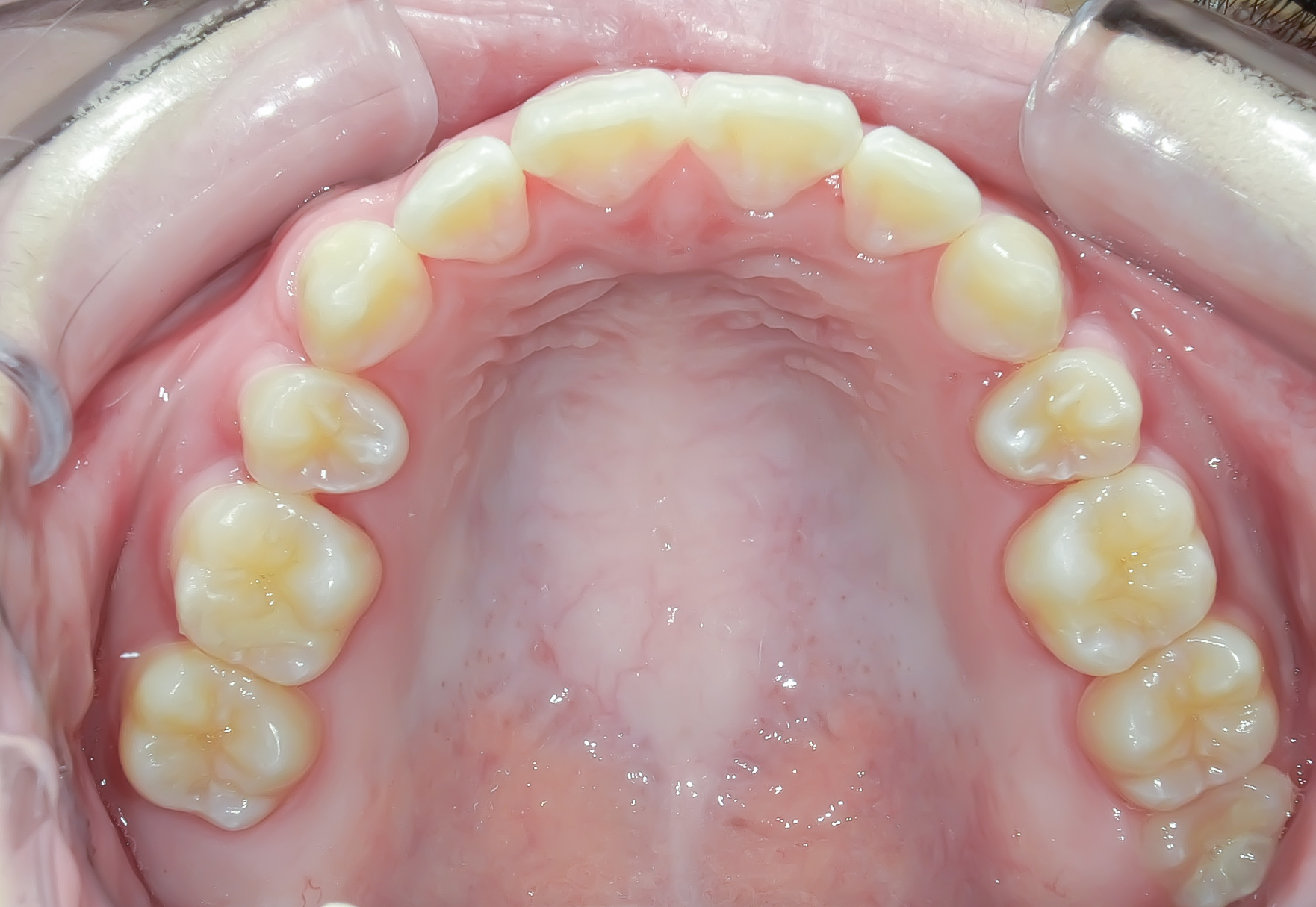 前歯のガタガタ、でっ歯に全体矯正を行なった症例治療方法05