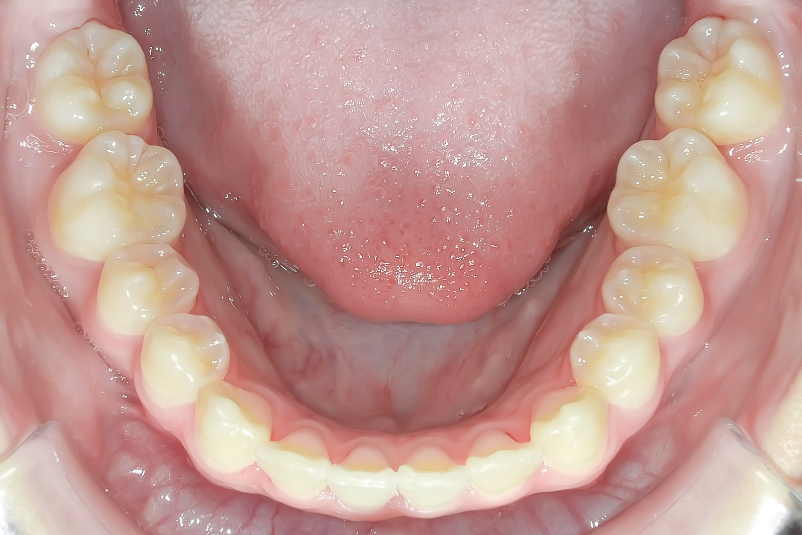 前歯のガタガタ、でっ歯に全体矯正を行なった症例治療方法06