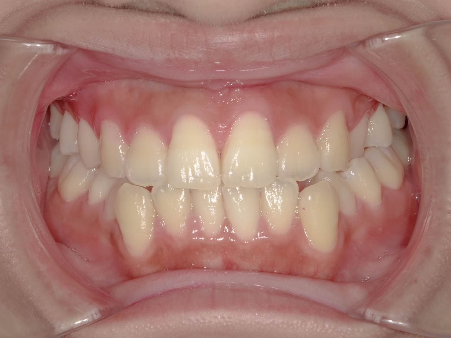 反対咬合（受け口）の矯正治療治療方法01