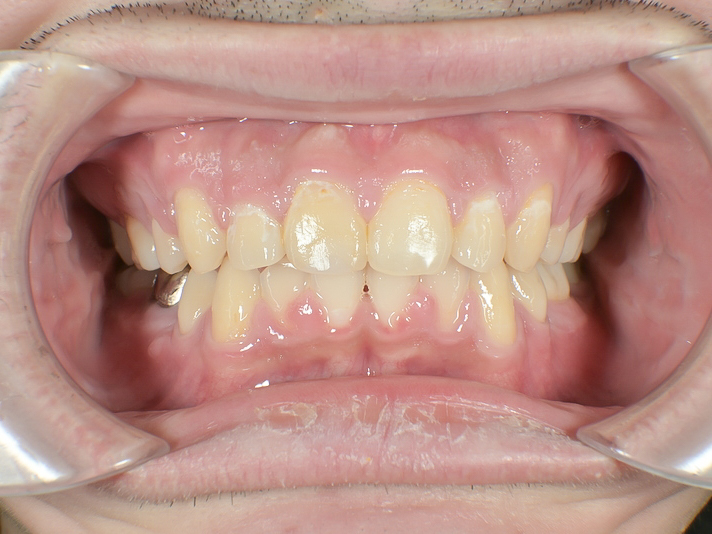 歯科矯正用アンカースクリューを用いて叢生と上下歯列正中の不一致を改善した症例治療方法07