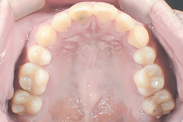 歯科矯正用アンカースクリューを用いて叢生と上下歯列正中の不一致を改善した症例治療方法08