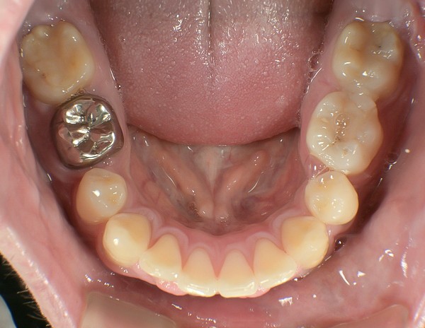 歯科矯正用アンカースクリューを用いて叢生と上下歯列正中の不一致を改善した症例治療方法09