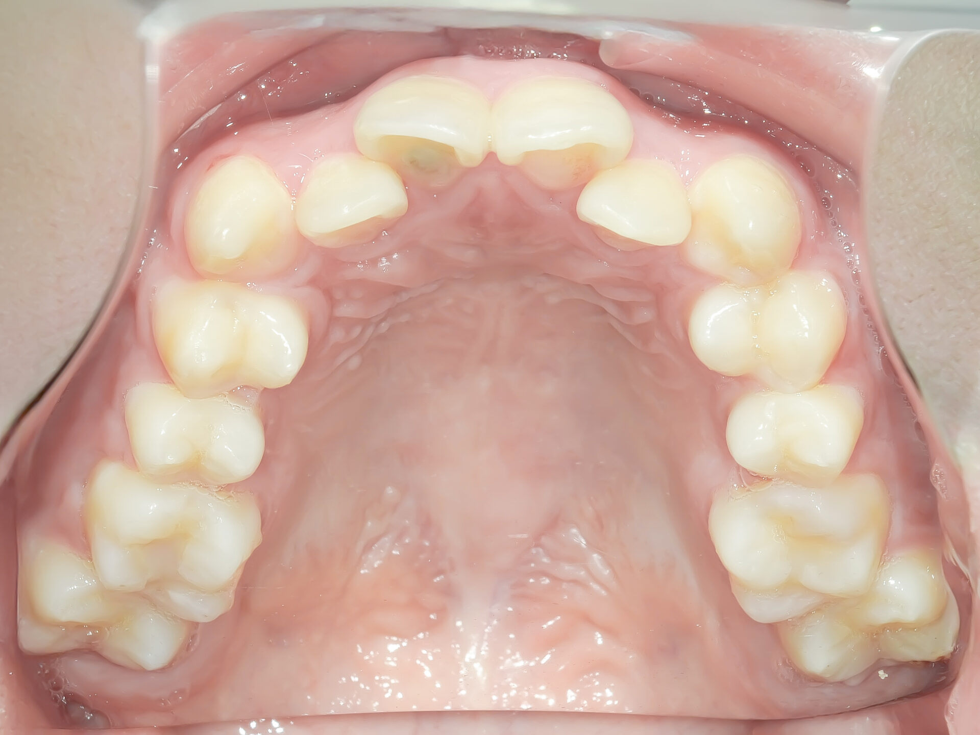 歯科矯正用アンカースクリューを用いて叢生と上下歯列正中の不一致を改善した症例治療方法01