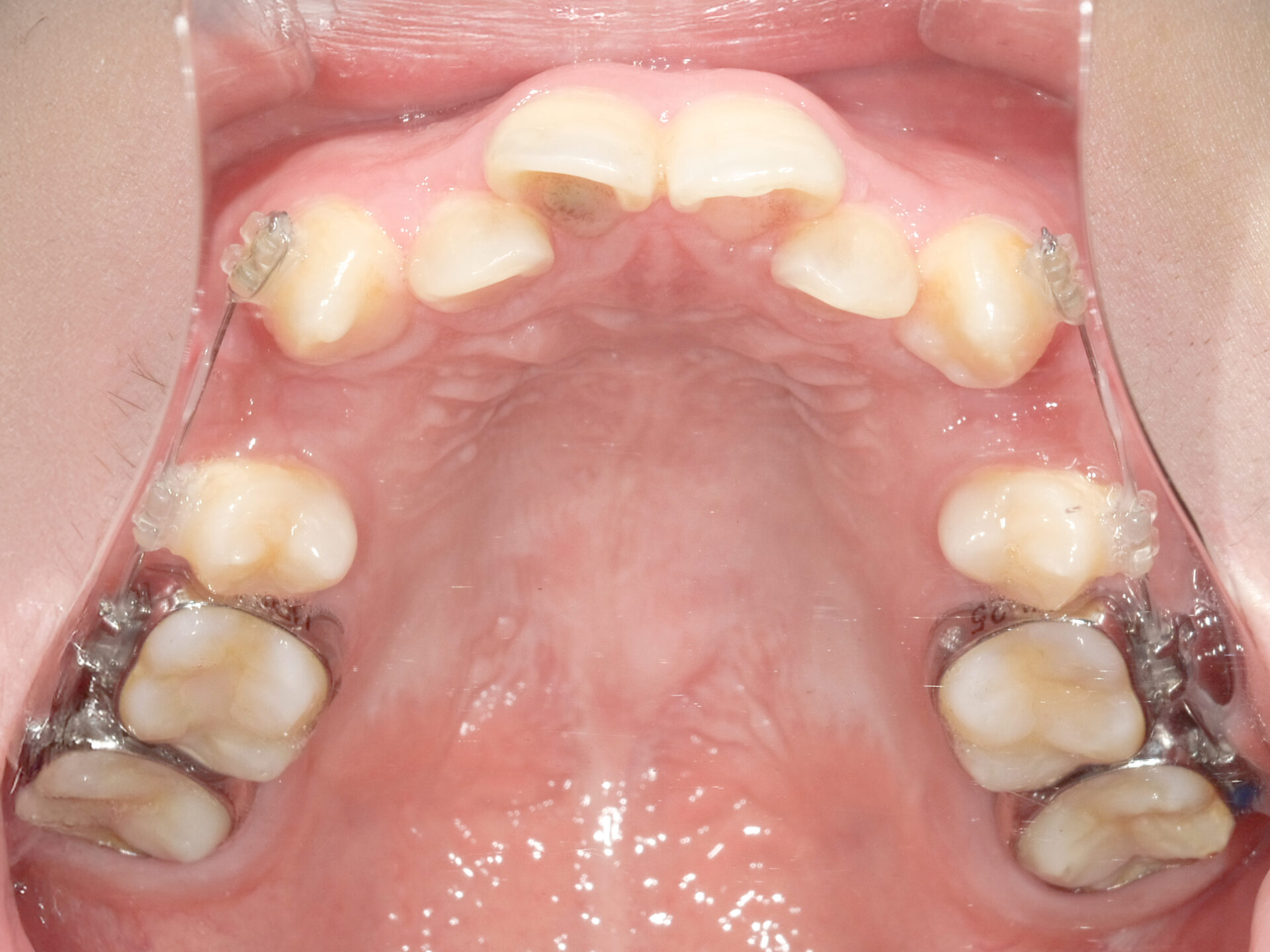 歯科矯正用アンカースクリューを用いて叢生と上下歯列正中の不一致を改善した症例治療方法03