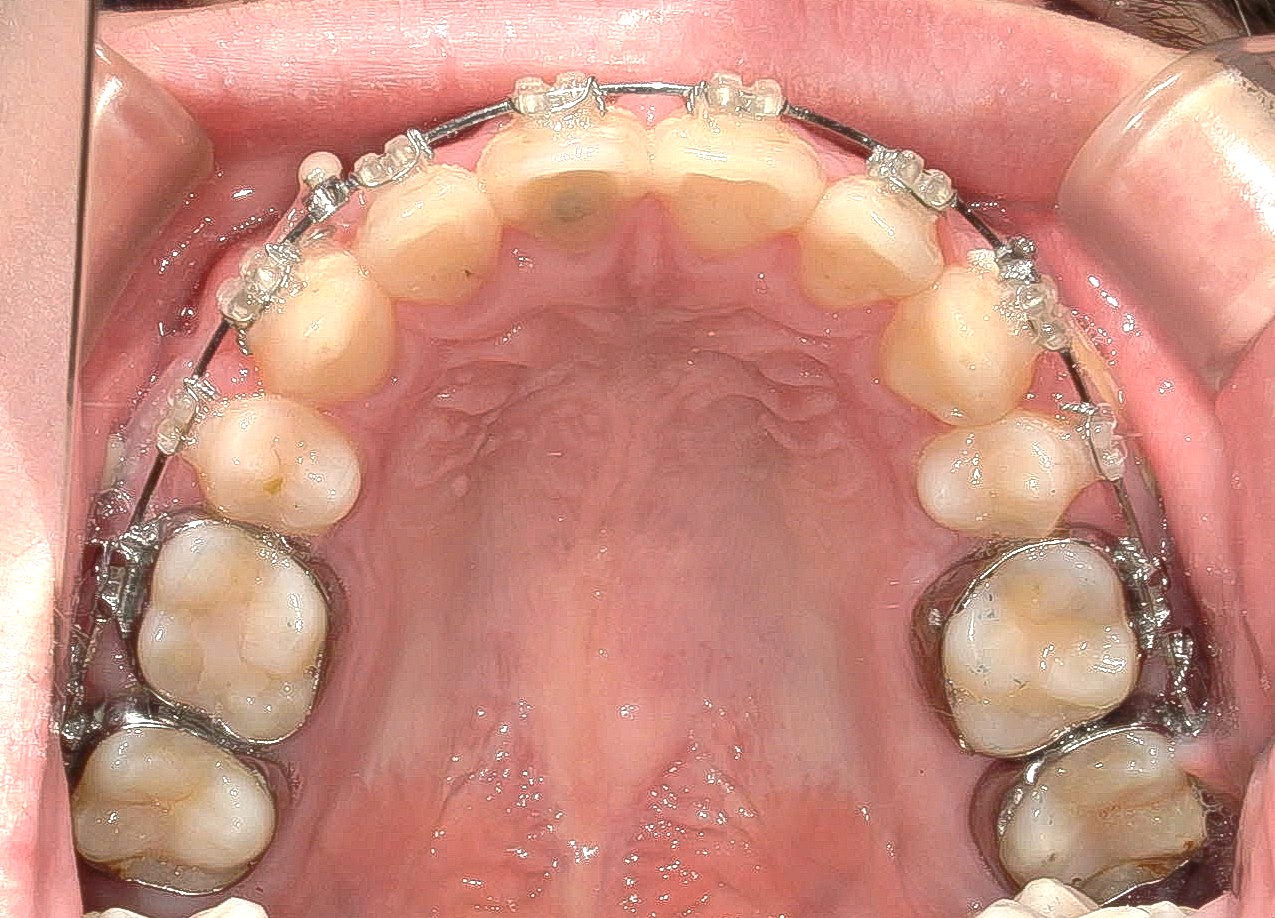 歯科矯正用アンカースクリューを用いて叢生と上下歯列正中の不一致を改善した症例治療方法04