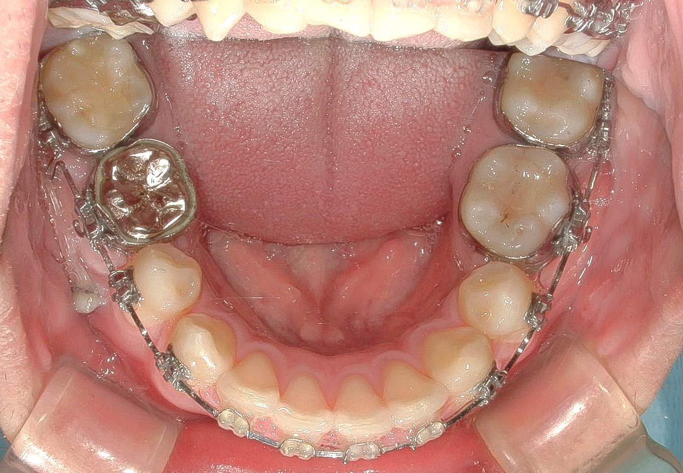歯科矯正用アンカースクリューを用いて叢生と上下歯列正中の不一致を改善した症例治療方法05