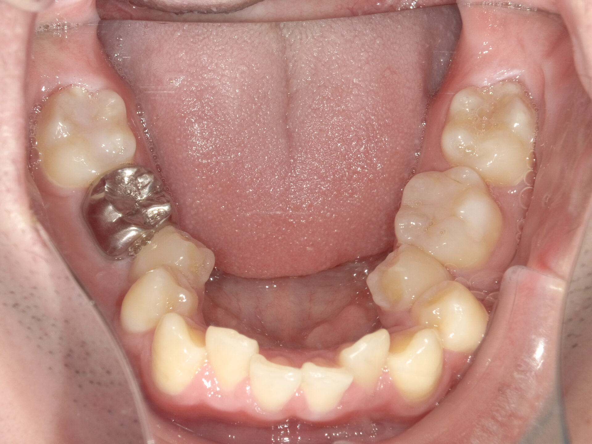 歯科矯正用アンカースクリューを用いて叢生と上下歯列正中の不一致を改善した症例治療方法02