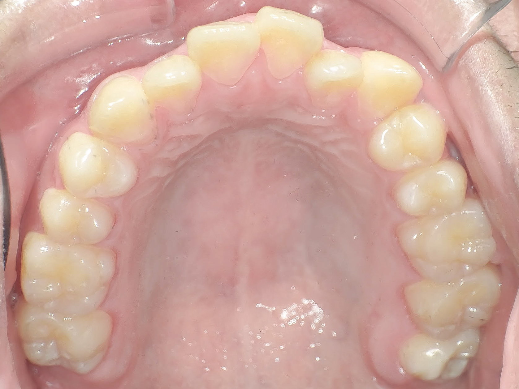オープンバイト・開咬を矯正治療で改善した症例治療方法02
