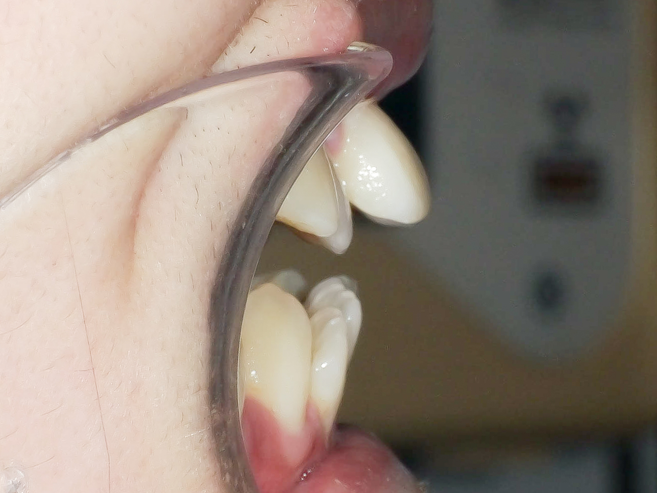 オープンバイト・開咬を矯正治療で改善した症例治療方法01