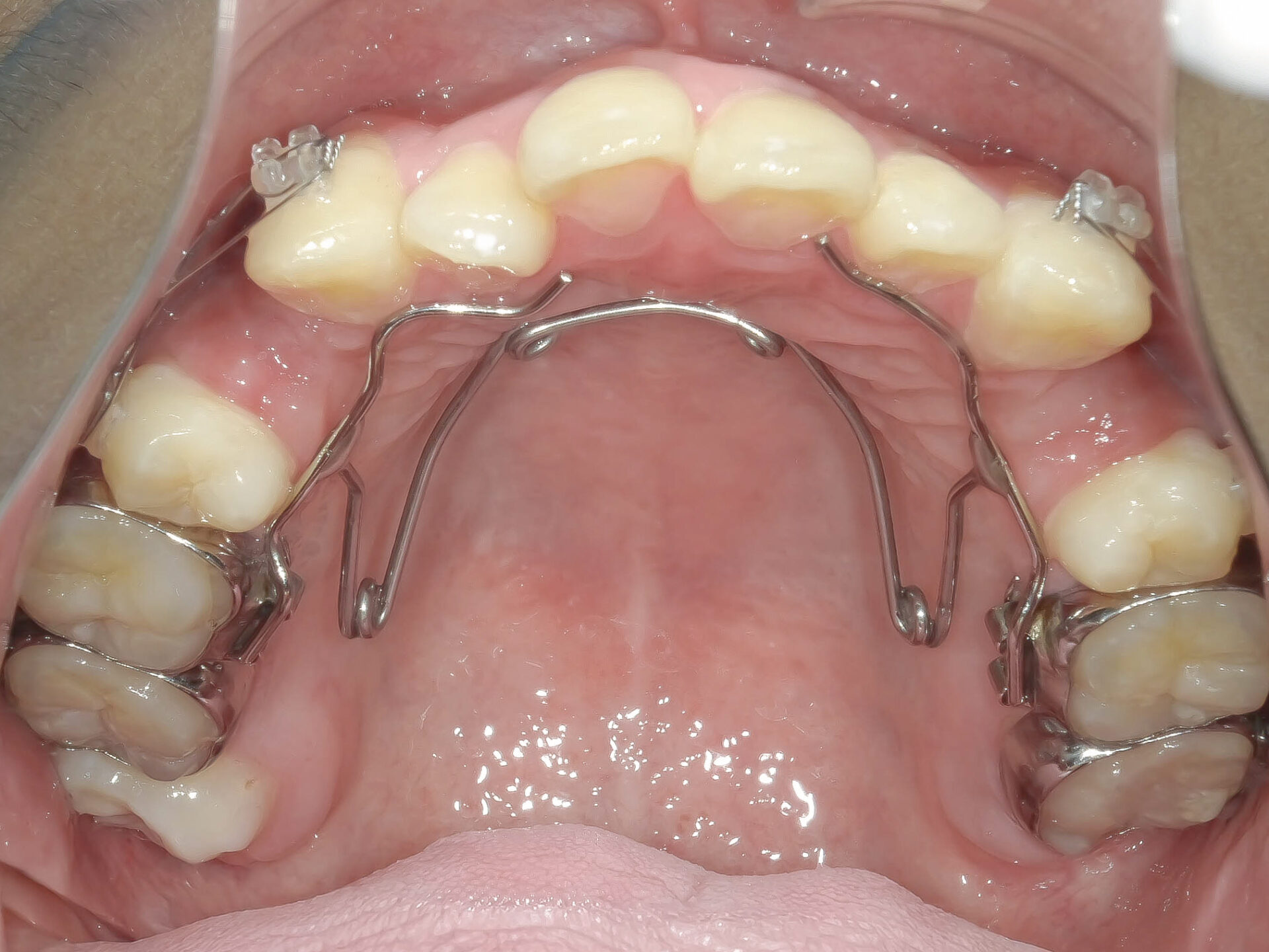 オープンバイト・開咬を矯正治療で改善した症例治療方法03