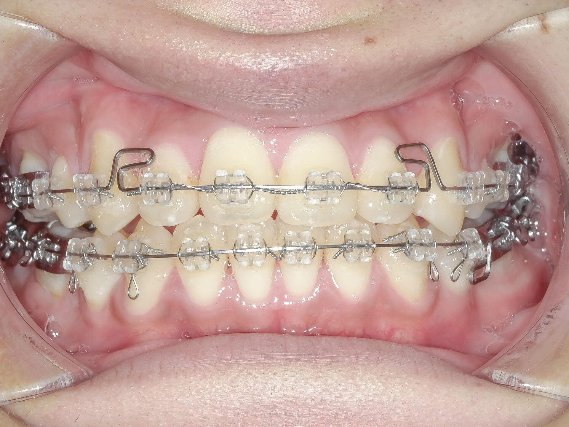 オープンバイト・開咬を矯正治療で改善した症例治療方法05