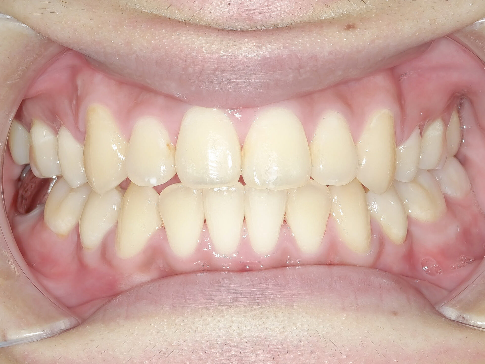 オープンバイト・開咬を矯正治療で改善した症例治療方法06