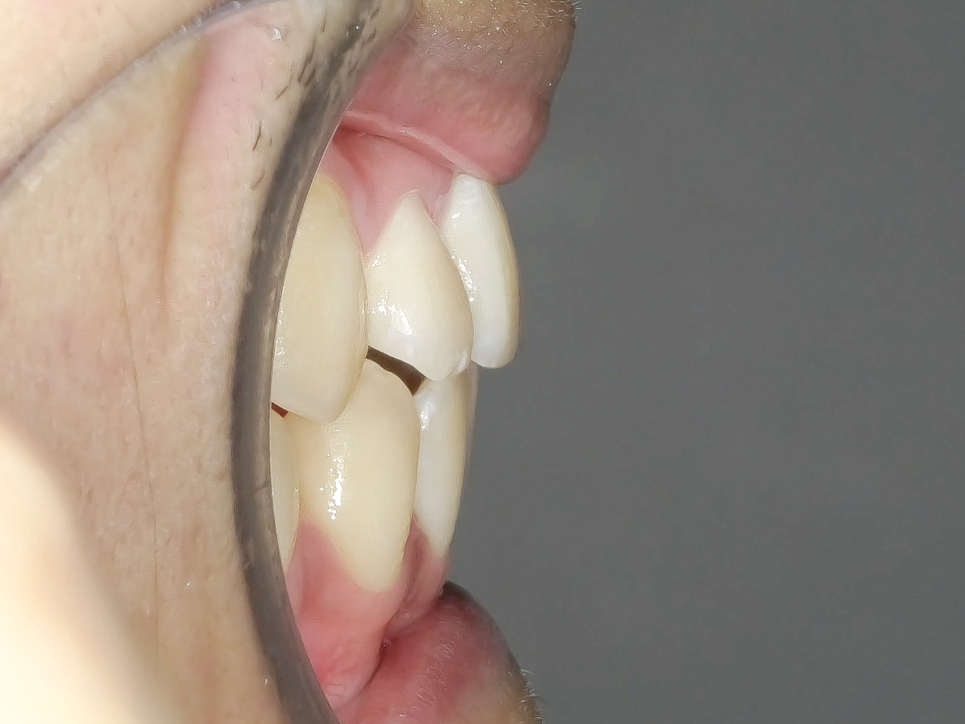 オープンバイト・開咬を矯正治療で改善した症例治療方法07