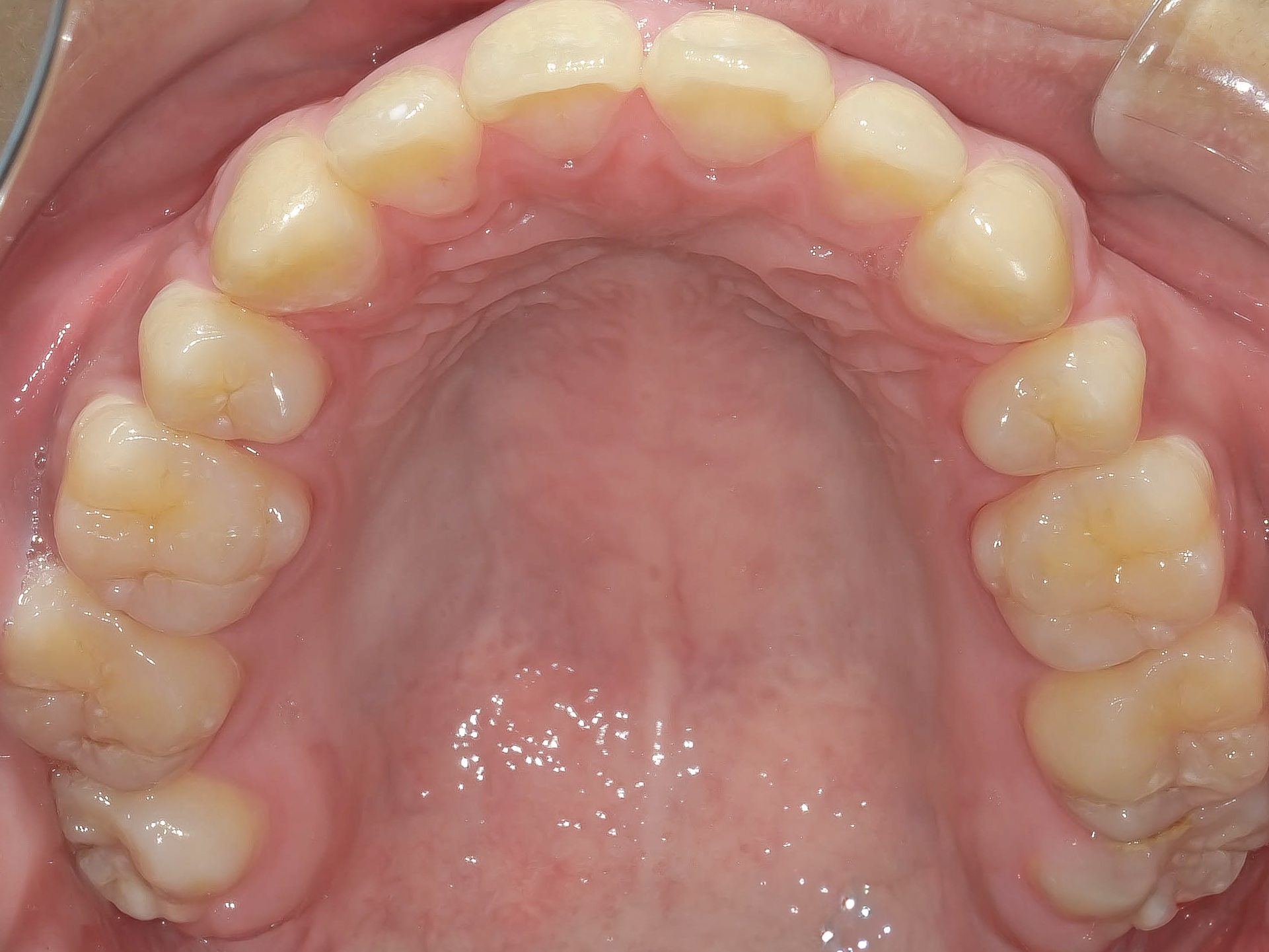 オープンバイト・開咬を矯正治療で改善した症例治療方法08