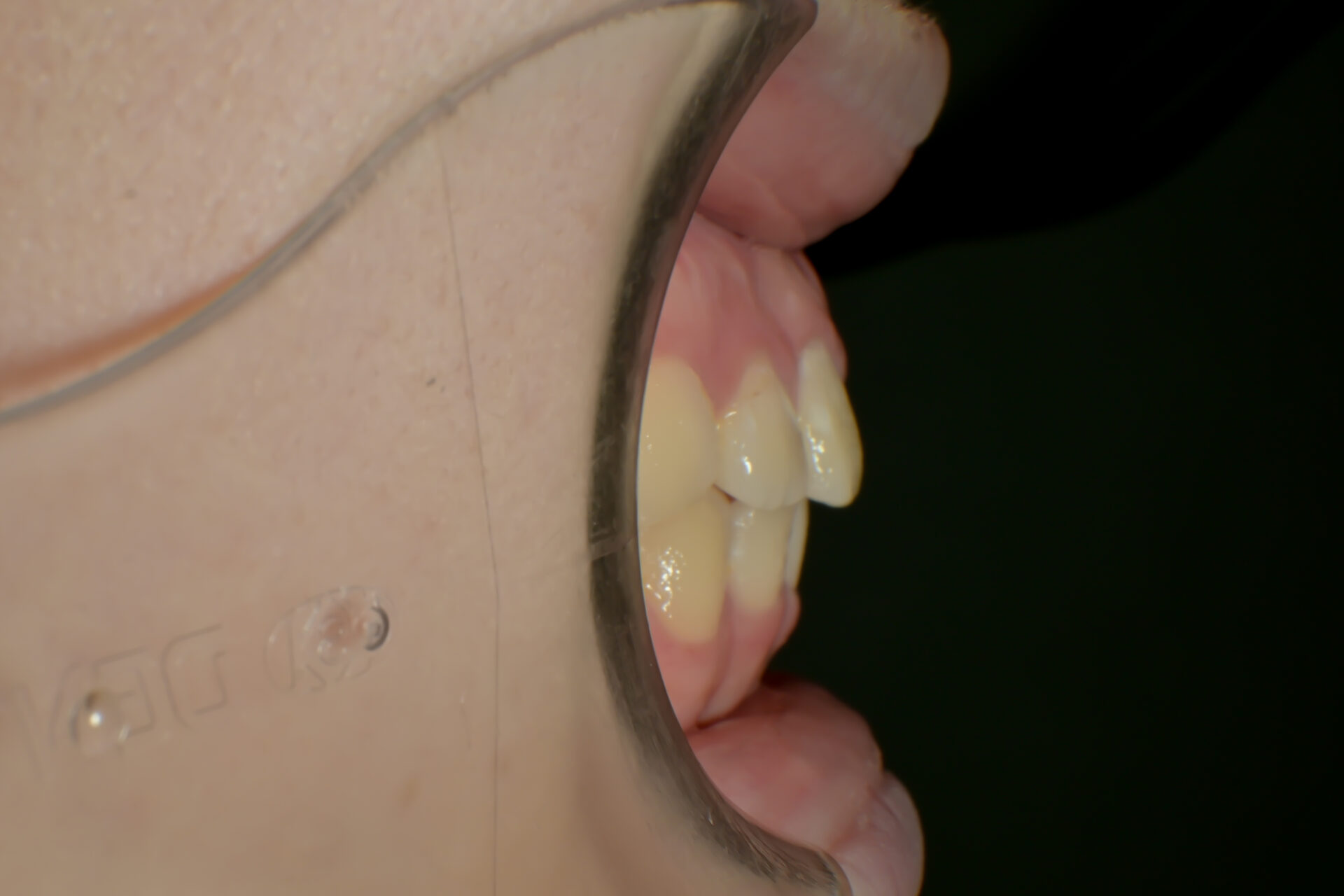 過蓋咬合(深い噛み合わせ)を改善した症例治療方法10